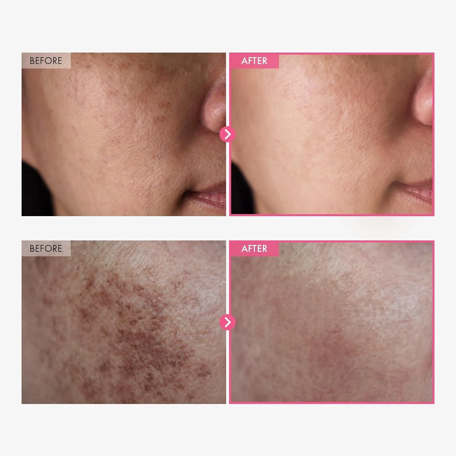 کرم آربوتین 7% + ترانگزامیک اسید 4%، کرم ضد لک پوست حاوی 70000ppm آربوتین، 40000ppm ترانگزامیک اسید، نیاسینامید و گلوتاتیون برای لکههای تیره، کک و مک، لکها و پیگمنتاسیون کرم آربوتین 7% + ترانگزامیک اسید 4%، کرم ضد لک پوست حاوی 70000ppm آربوتین، 40000ppm ترانگزامیک اسید، نیاسینامید و گلوتاتیون برای لکههای تیره، کک و مک، لکها و پیگمنتاسیون