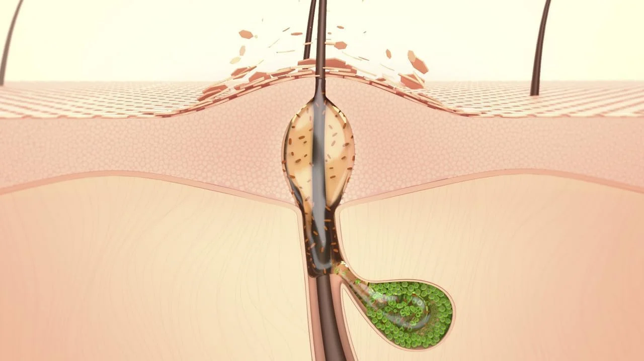 کرم ژل ضد جوش و ضد لک بایودرما سبیوم کراتو پلاس مناسب پوست های مختلط تا مستعد آکنه (حجم 30 میلی لیتر)