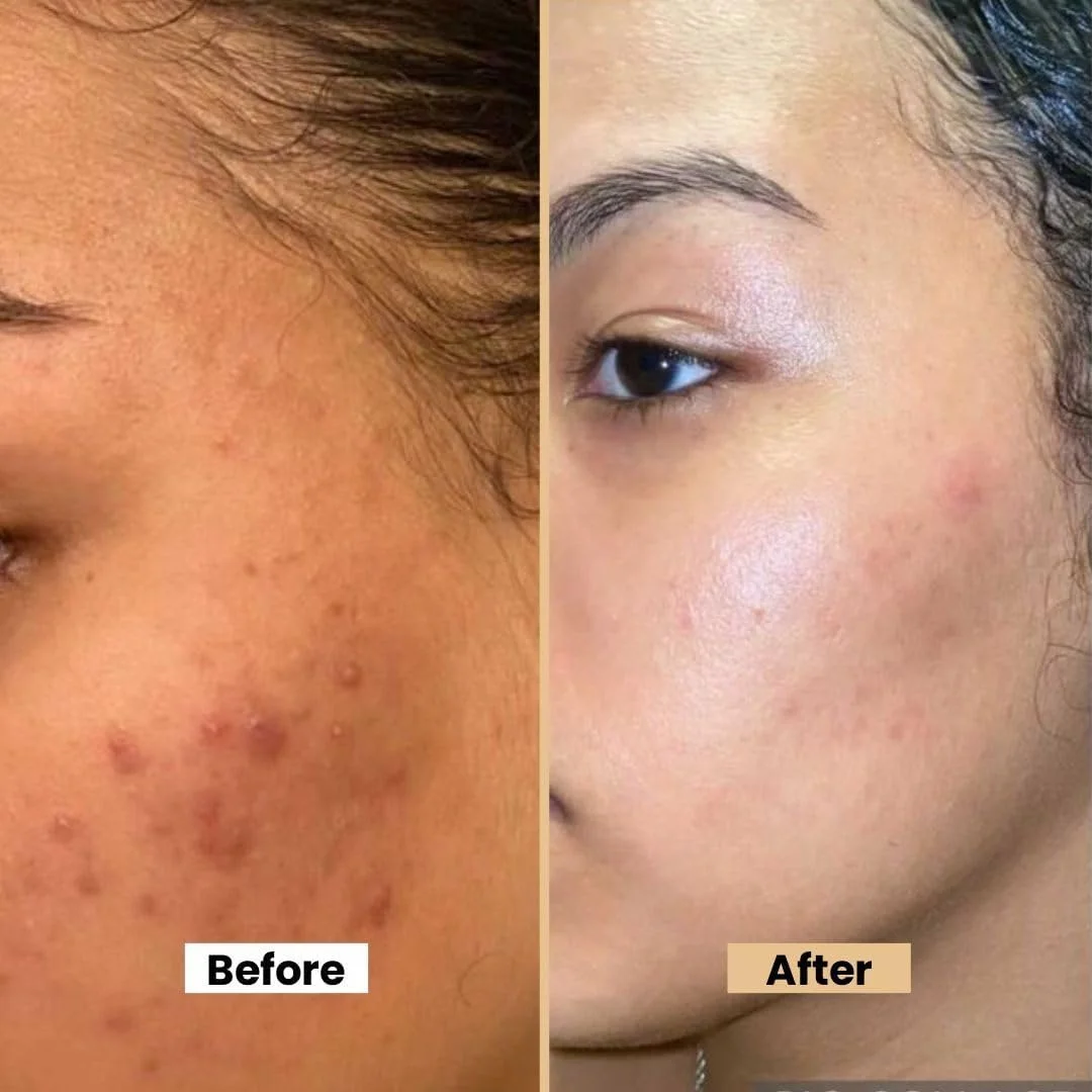 کرم صورت ضد جوش بایوکاس برای بانوان (بسته 2 عددی) – فرمول آبرسان با آلوئه ورا، چریش، زینک اکساید و خربزه تلخ – مناسب برای جوش ها، آکنه ها و لک ها – 12 گرم