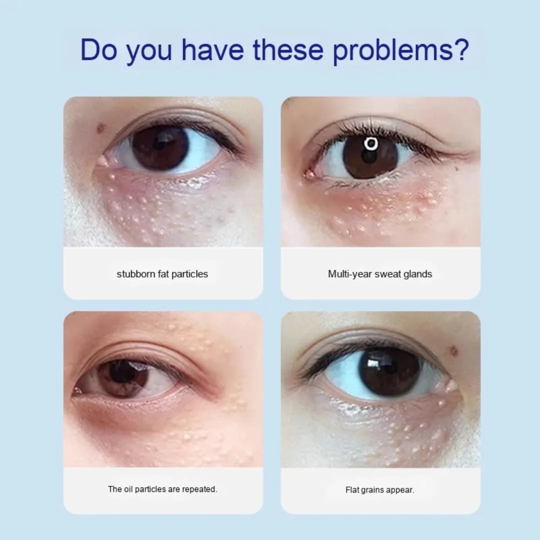 سرم از بین برنده دانه های چربی نیکیتا ویوی 30 میلی لیتر، درمان میلیوم، مایع ملایم و مرطوب کننده برای از بین بردن دانه های چربی و پوست صاف