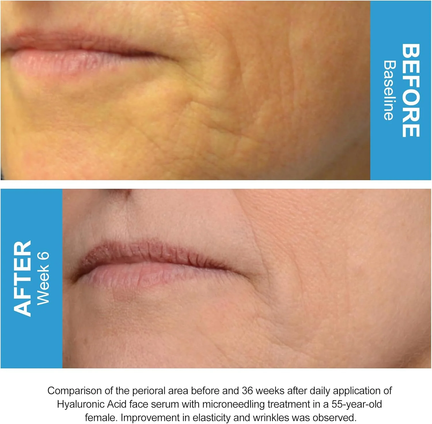 سرم صورت اسید هیالورونیک + 2% B5 سوتی - فرمول آبرسانی و مرطوب کننده نهایی برای پوستی جوان، شاداب با پپتیدها، ویتامین B5، عصاره ریوکوچا، ضد پیری و روشن کننده 30 میلی لیتر - تصویر 3 سرم صورت اسید هیالورونیک + 2% B5 سوتی - فرمول آبرسانی و مرطوب کننده نهایی برای پوستی جوان، شاداب با پپتیدها، ویتامین B5، عصاره ریوکوچا، ضد پیری و روشن کننده 30 میلی لیتر - تصویر 3