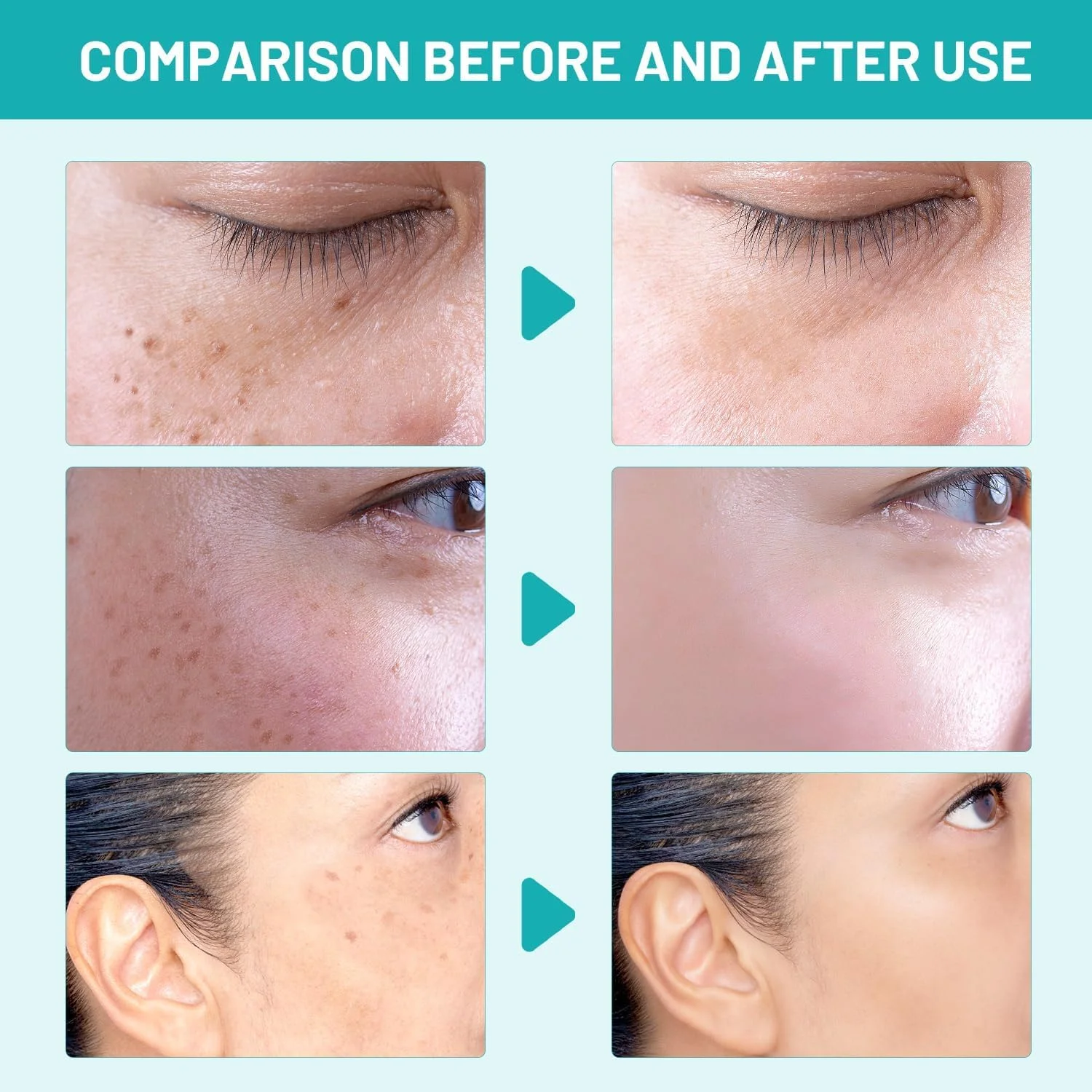 سرم رفع لکههای تیره صورت، سرم لکههای تیره با نیاسینامید رتینول برای لکههای ناشی از آفتاب، لکههای پیری، لکههای قهوهای، جای زخم آکنه و لکههای قهوهای ملاسما، فرمول پیشرفته برای زنان و مردان (30 گرم) - 2 عدد سرم رفع لکههای تیره صورت، سرم لکههای تیره با نیاسینامید رتینول برای لکههای ناشی از آفتاب، لکههای پیری، لکههای قهوهای، جای زخم آکنه و لکههای قهوهای ملاسما، فرمول پیشرفته برای زنان و مردان (30 گرم) - 2 عدد