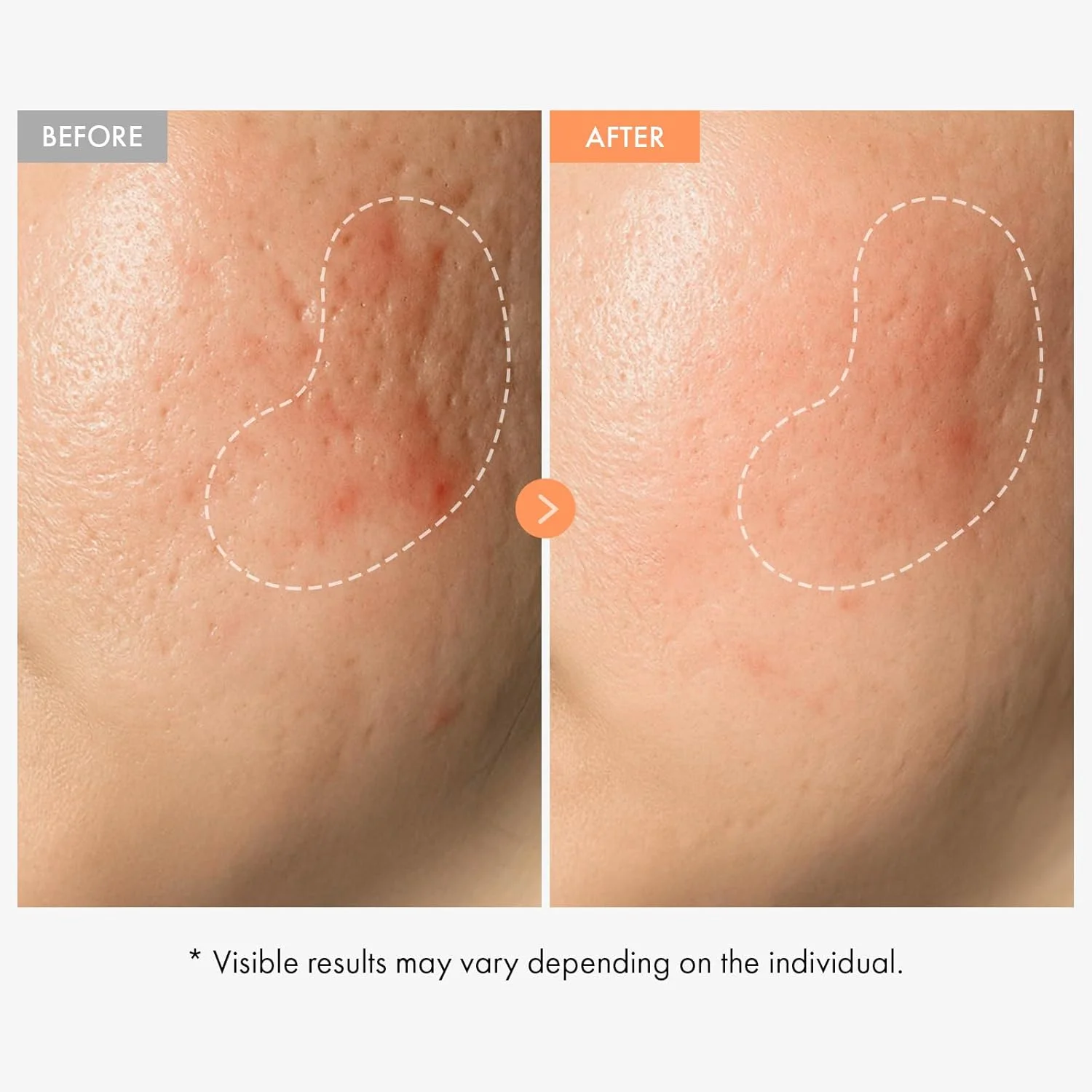 آمپول نیاسینامید ویتامین – سرم ویتامین B3 با 20000ppm پانتنول – کمک به بهبود ظاهر رنگ ناهموار، پوست کدر و خطوط ریز – مراقبت از پوست کره ای، 100 میلی لیتر