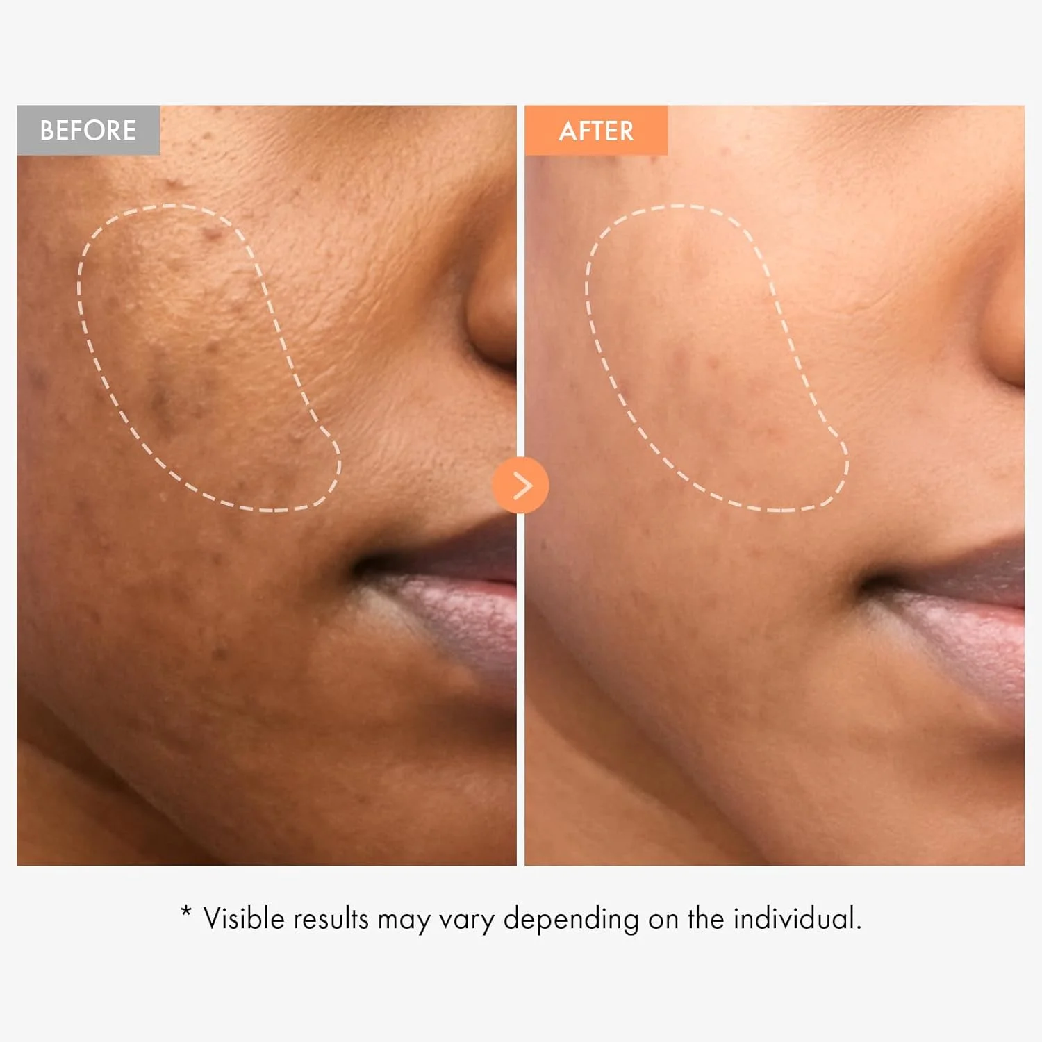 آمپول نیاسینامید ویتامین – سرم ویتامین B3 با 20000ppm پانتنول – کمک به بهبود ظاهر رنگ ناهموار، پوست کدر و خطوط ریز – مراقبت از پوست کره ای، 100 میلی لیتر