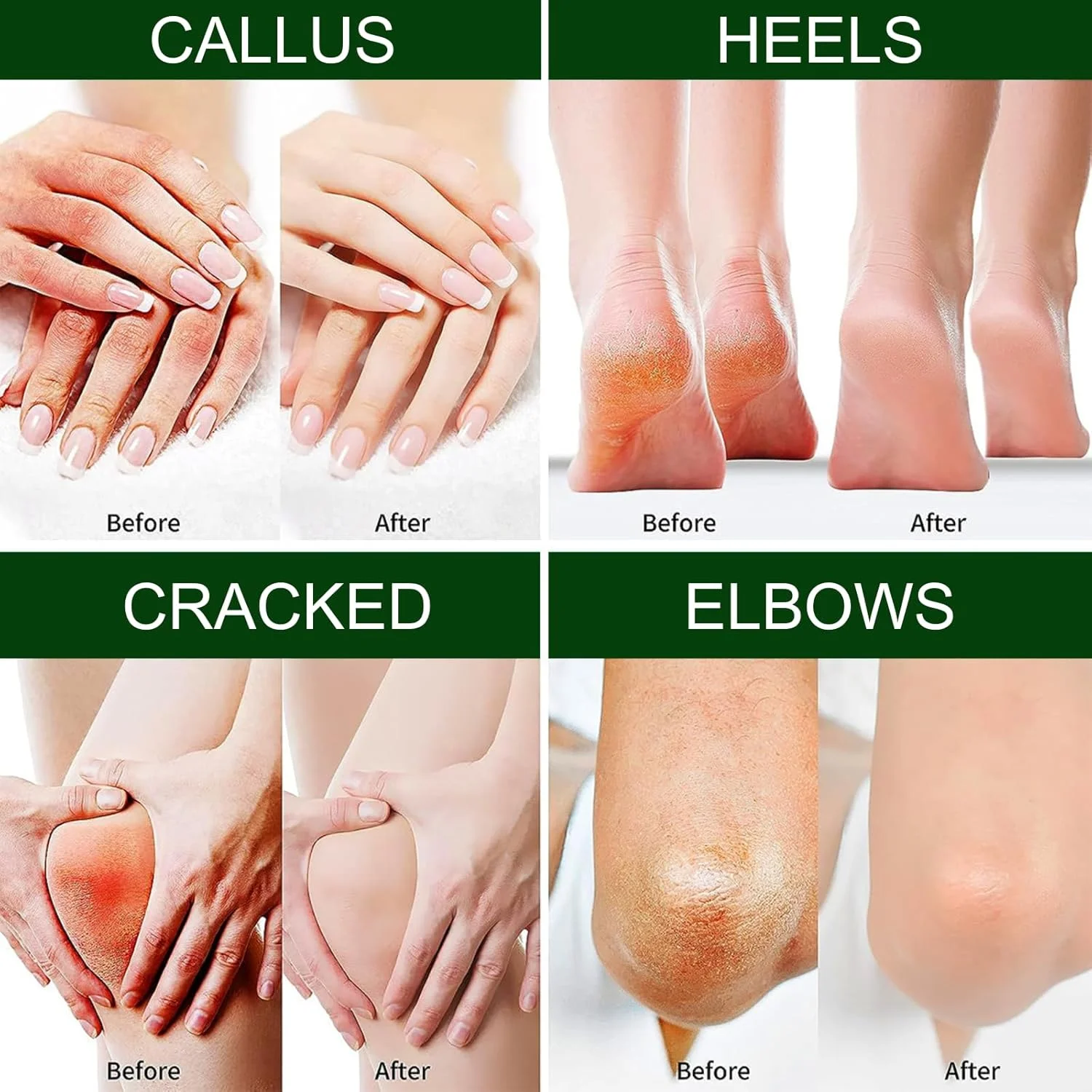 کرم پا حاوی روغن درخت چای برای پاشنه های ترک خورده و پینه بسته، کرم مرطوب کننده پا و دست برای پوست های سخت، درمان ترمیم کننده و نرم کننده عمیق برای پاها، ایده آل برای مراقبت روزانه از پا