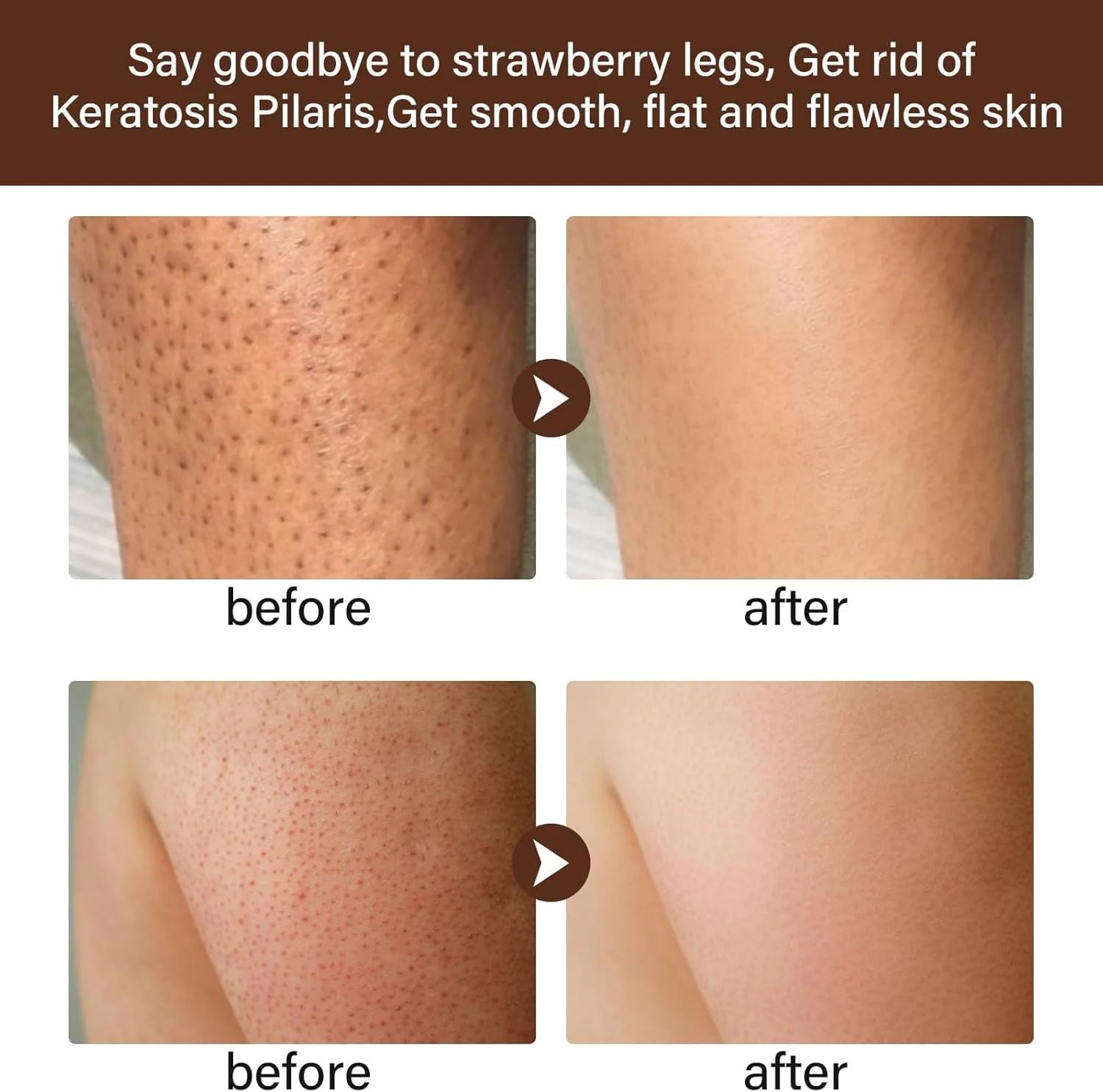 کرم درمان پوست مرغی برای بانوان، کرم بدن زبر و ناهموار، لوسیون برای پوست خشک، از بین برنده پوست مرغی، کرم مرطوب کننده درمان کراتوز پیلاریس برای روشن کردن لکه ها و خشکی