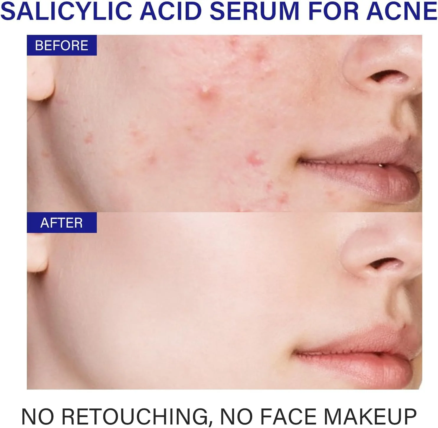 سرم ۲% سالیسیلیک اسید برای درمان آکنه صورت، سرم آکنه برای پوست چرب، سرم های مرطوب کننده صورت برای جوش، از بین برنده جوش های سرسیاه و سرسفید، کوچک کننده منافذ