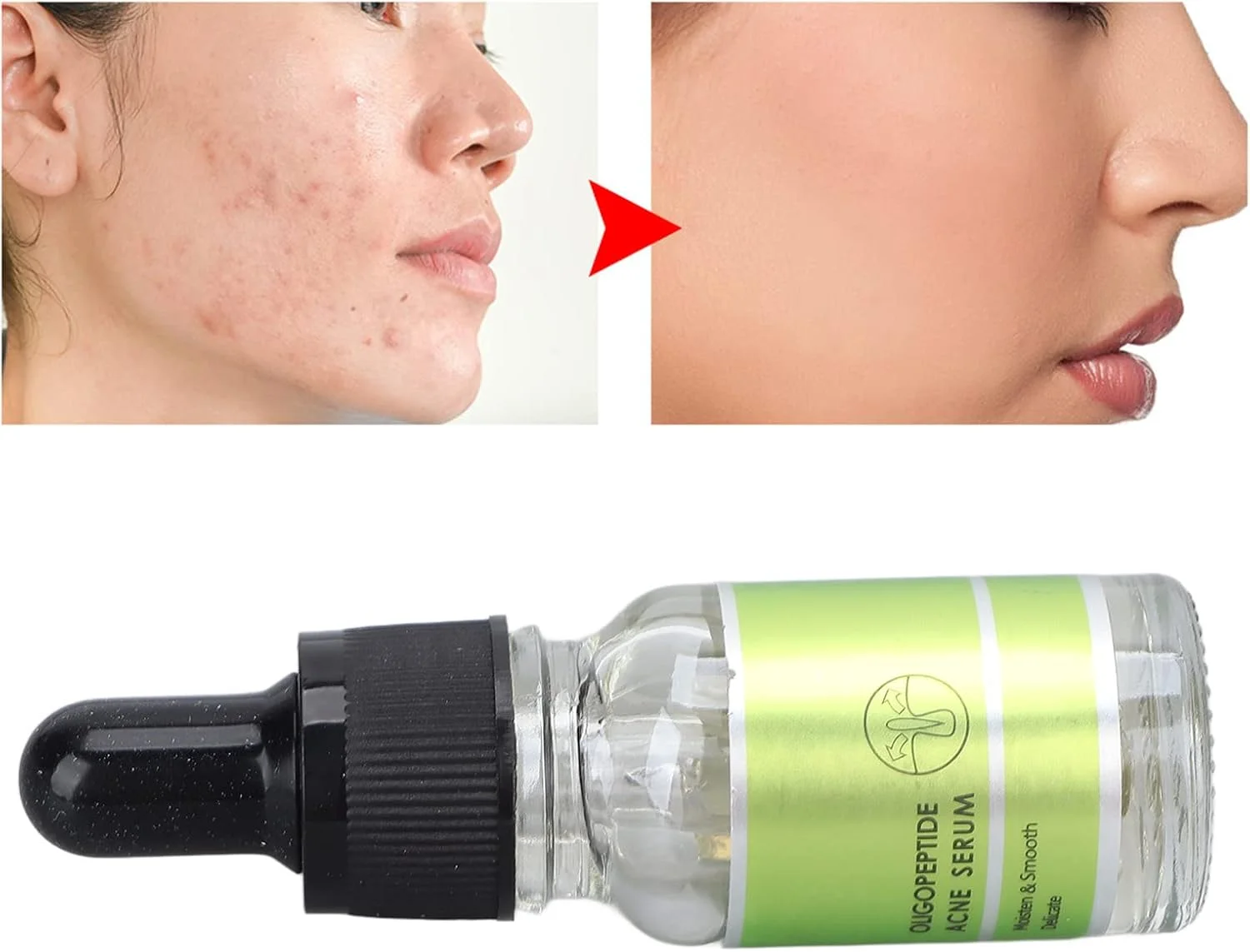 سرم الیگوپپتید ضد آکنه، سرم مرطوب کننده صورت، درمان لک صورت 10 میلی لیتر