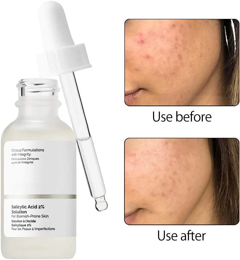 محلول لایه بردار، اسانس 2% سالیسیلیک اسید از بین برنده جوش های سرسیاه 30 میلی لیتر، سرم اسانس صورت سالیسیلیک اسید، مایع از بین برنده جوش های سرسیاه