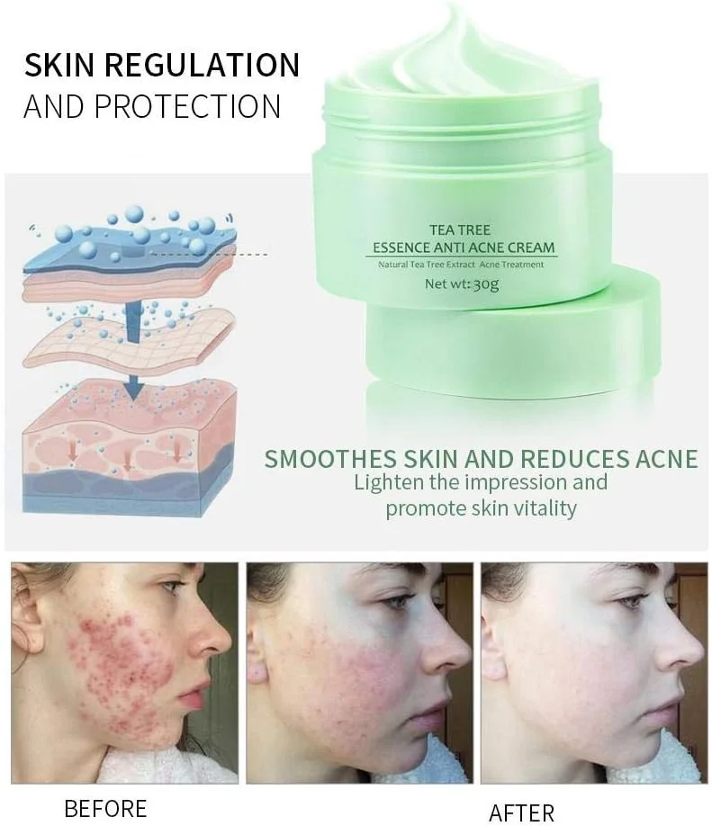 کرم درمان آکنه، درمان آکنه، سرم درخت چای، کرم ترمیم کننده صورت ضد آکنه