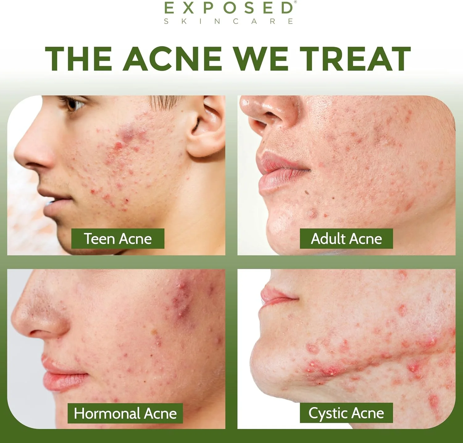 مجموعه مراقبت از پوست در معرض آکنه - شامل پاک کننده صورت، تونیک پاک کننده، سرم درمان آکنه، سرم پاک کننده منافذ، ماسک شفاف کننده، پارچه - محلول طبیعی آکنه برای صورت، تمام سنین و انواع پوست