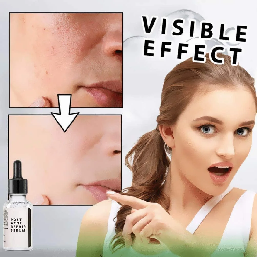 اسانس درمان پوست، درمان جای پوست 30 میلی لیتر، اسانس صورت، محو کننده جای پوست و سرم صورت برای لک و مراقبت از پوست اسانس درمان پوست، درمان جای پوست 30 میلی لیتر، اسانس صورت، محو کننده جای پوست و سرم صورت برای لک و مراقبت از پوست