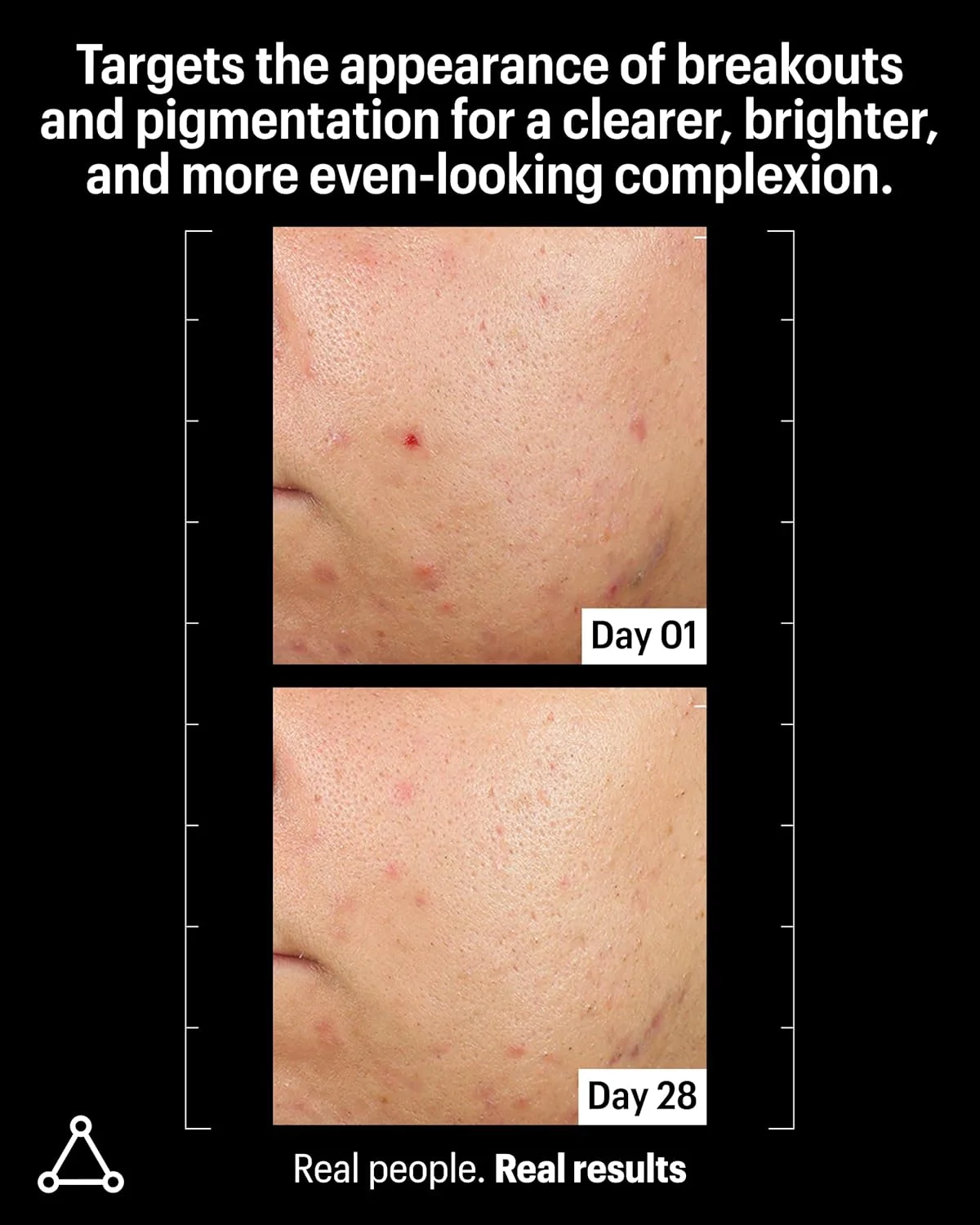 سرم روشن کننده صورت آزالئیک و کوجیک اسکین الیز | از نظر بالینی برای پوست های مستعد آکنه و لک ثابت شده است | 10% آزالئیک اسید رنگدانه ها و قرمزی را درمان می کند | منافذ و بافت ناهموار پوست را هدف قرار می دهد (30 میلی لیتر)