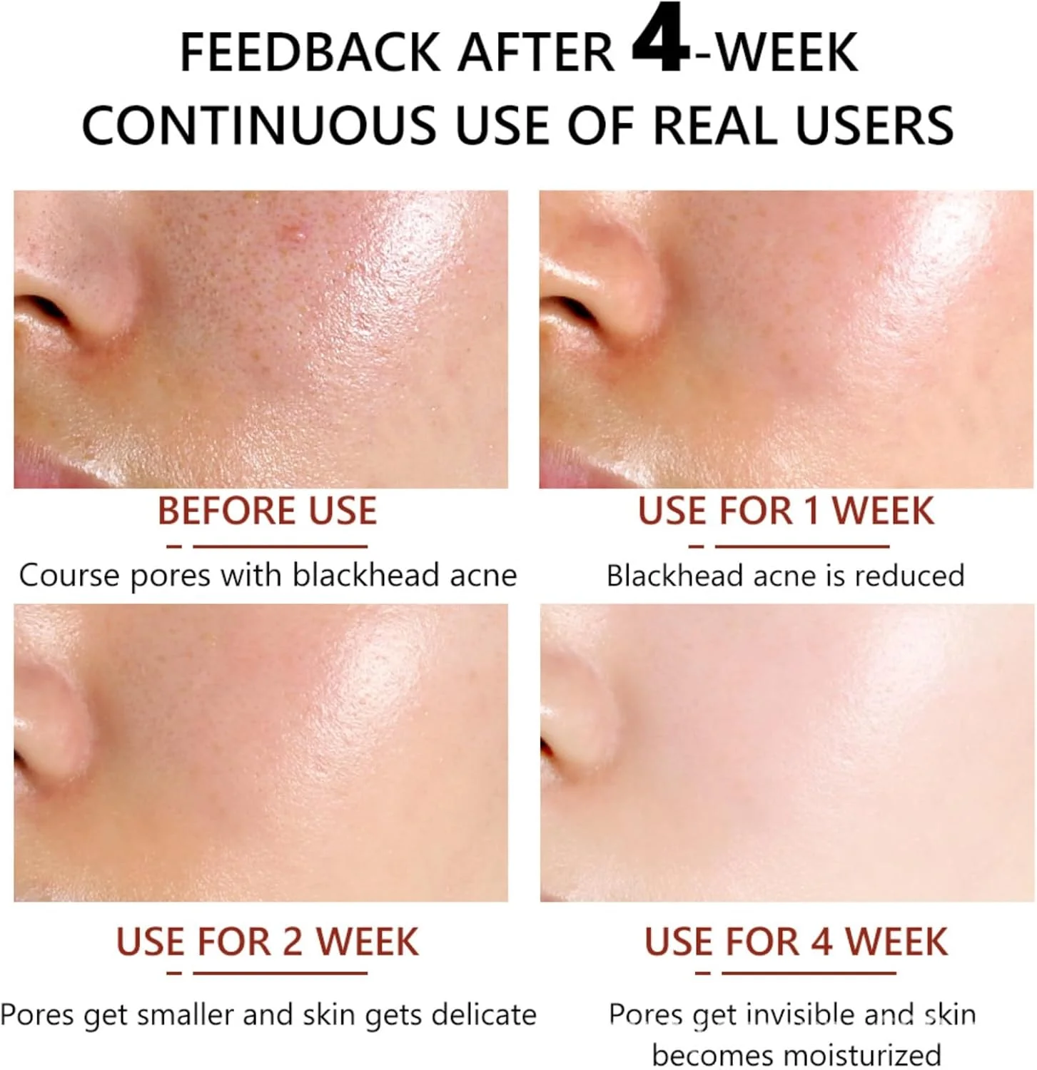 سرم کوچک کننده منافذ پوست 30 میلی لیتر حاوی اسید سالیسیلیک، کاهش دهنده جوش های سرسیاه و لک ها، دارای اثرات کوچک کننده منافذ، فرمول آبرسان، فرمول با نفوذ عمیق، استفاده آسان برای انواع پوست