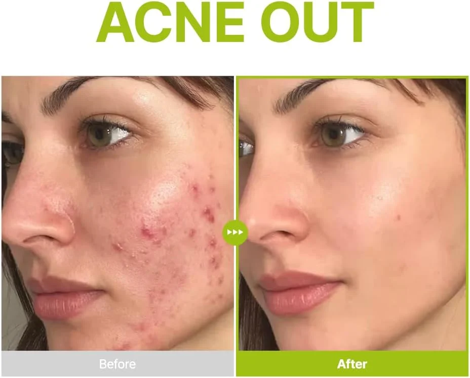 سرم صورت پوریتو حاوی آزلائیک اسید 10%، کوجیک و درخت چای، سرم صورت کره‌ای برای پوست مستعد جوش، لک، مراقبت از منافذ و یکدست کردن رنگ پوست، فرمول فعال سه گانه 20% حاوی کپسول‌های درخت چای، 30 میلی لیتر