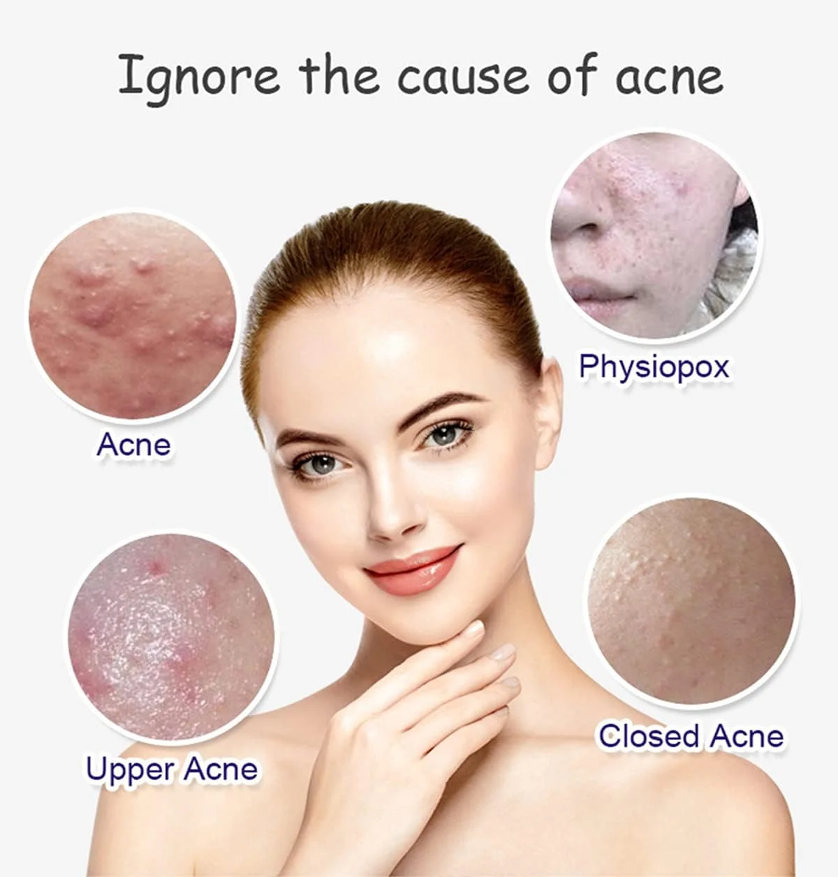 سرم صورت ضد جوش آلوئه ورا ایچون بیوتی حاوی عصاره آلوئه ورا و اسید سالیسیلیک، ترمیم کننده پوست آسیب دیده، 30 میلی لیتر