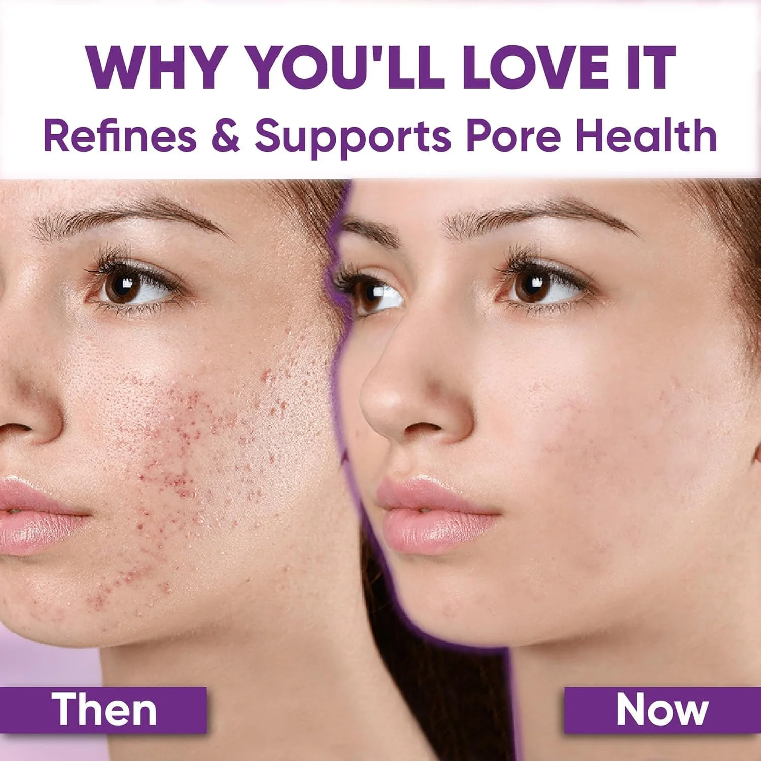 کرم ضد جوش حاوی 14% آزلائیک اسید丨سرم پیشرفته آزلائیک اسید丨تسکین دهنده قرمزی صورت، مراقبت از پوست کاهش دهنده قرمزی丨جلوگیری از ایجاد جوش، تسکین جوش ها، شفاف کننده پوست، التیام بخش تحریکات کرم ضد جوش حاوی 14% آزلائیک اسید丨سرم پیشرفته آزلائیک اسید丨تسکین دهنده قرمزی صورت، مراقبت از پوست کاهش دهنده قرمزی丨جلوگیری از ایجاد جوش، تسکین جوش ها، شفاف کننده پوست، التیام بخش تحریکات