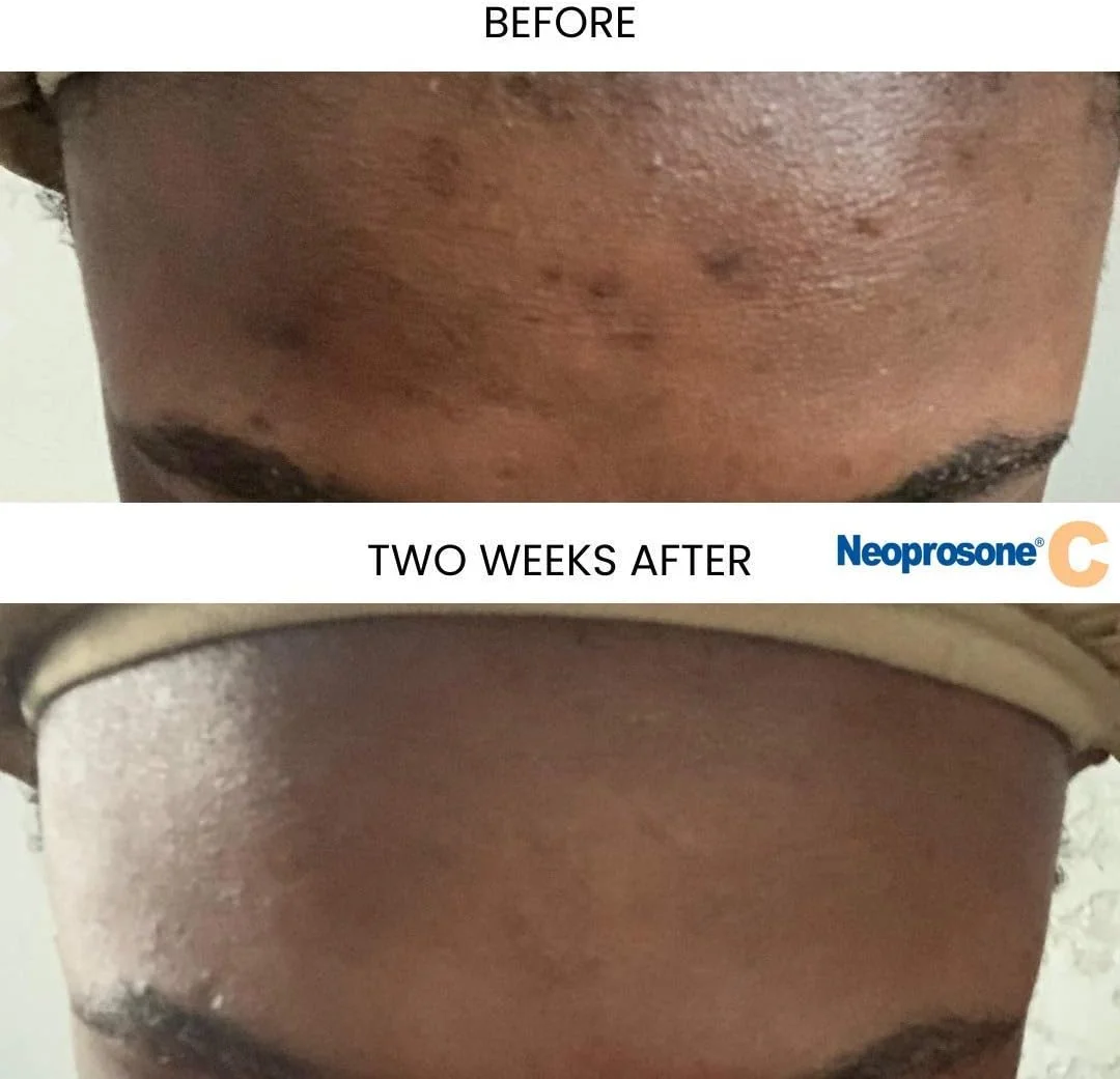 سرم روشن کننده ویتامین C نئوپروزون | 30 میلی لیتر | سرم اصلاح کننده لک تیره صورت | سرم صورت ضد چروک | سرم آبرسان و مرطوب کننده صورت با آلفا آربوتین و روغن کرچک