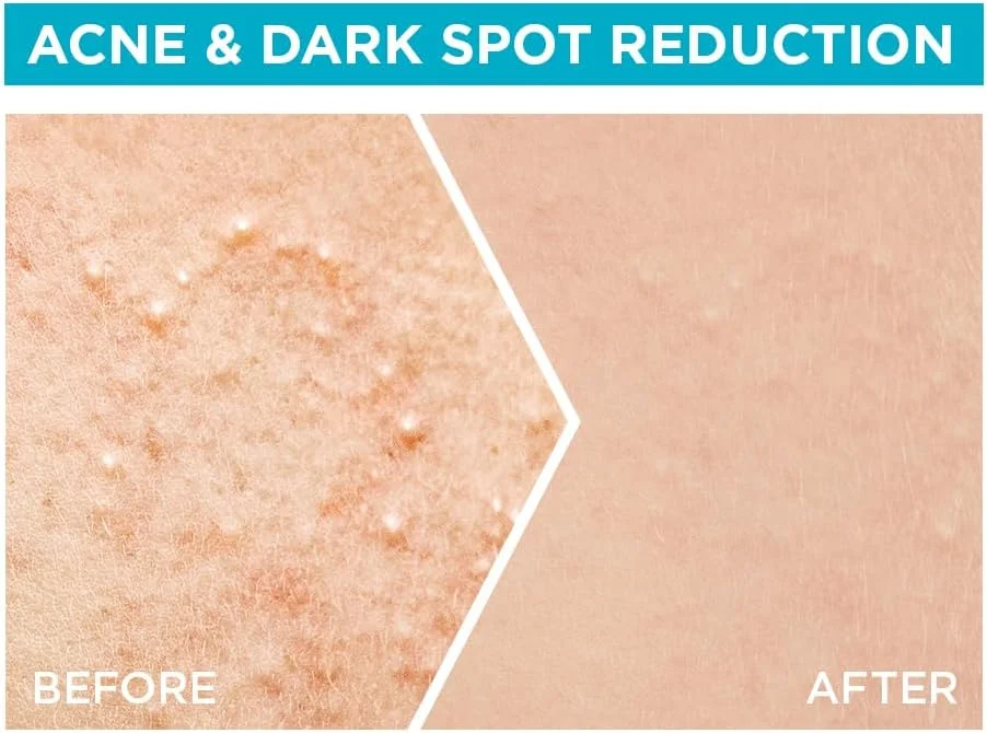 سرم تقویت کننده سریع پوست صورت Garnier Skinactive، حاوی اسید سالیسیلیک، 30 میلی لیتر