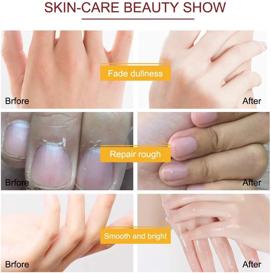 ماسک دست ALIVER، 5 جفت دستکش مرطوب کننده دست، ماسک ترمیم کننده دست برای پوست بسیار خشک، ماسک لایه بردار دست، ترمیم پوست زبر برای آقایان و خانم ها (C)