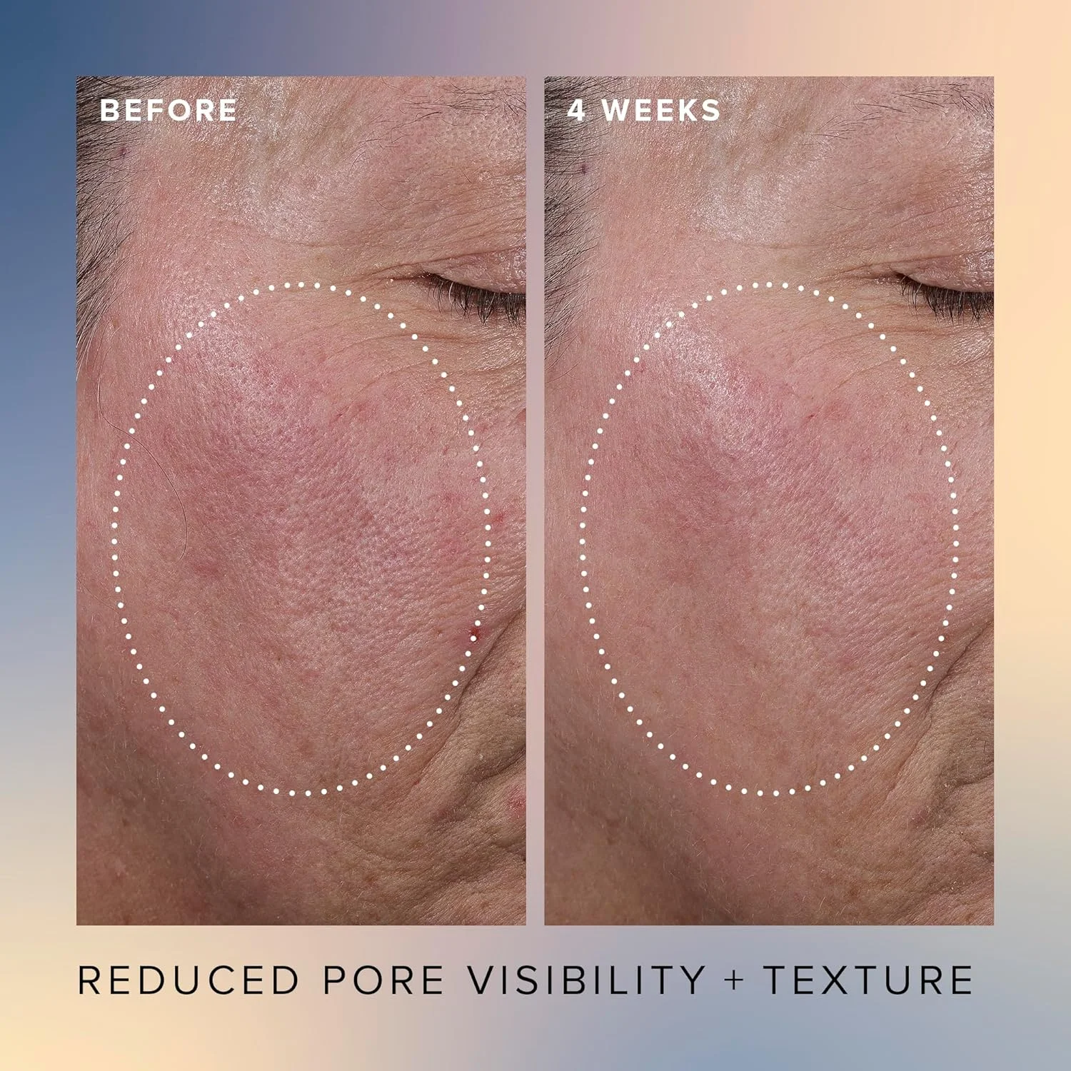 سرم شب لایه بردار حاوی 17% AHA و BHA فارماسی هانی گلو - سرم صورت حاوی اسید هیالورونیک - کاهش خطوط ریز و منافذ (30 میلی لیتر)