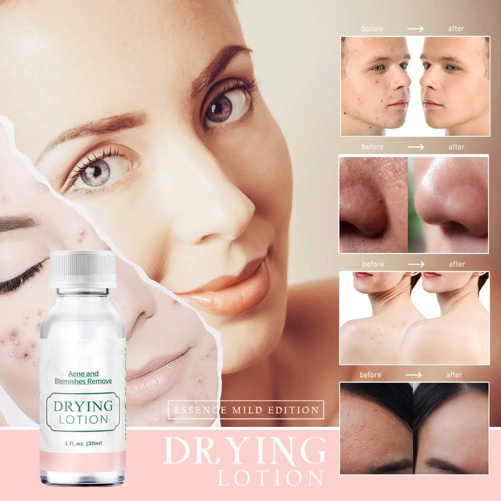 سرم صورت برای آکنه، لوسیون مات کننده مراقبت از پوست 30 میلی لیتر، سرم صورت برای رفع لک های آکنه، سرم روشن کننده و لایه بردار پوست صورت برای جای زخم های آکنه، محو کننده حلقه های تیره، ضد التهاب و ضد آکنه