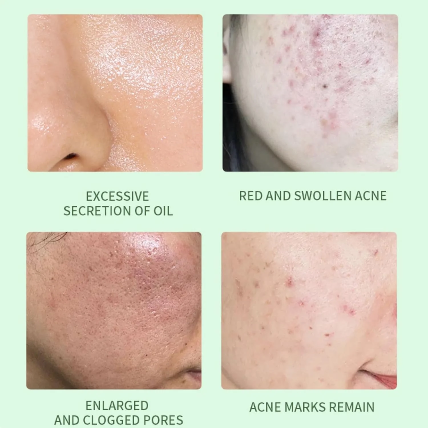 سرم ۲% سالیسیلیک اسید FUIN برای کنترل آکنه و لک، درمان لایه برداری کاهش دهنده هایپرپیگمنتیشن، فرمول متعادل کننده چربی، کوچک کننده منافذ و نقاط تیره، مراقبت روزانه صورت برای پوستی صاف و شفاف