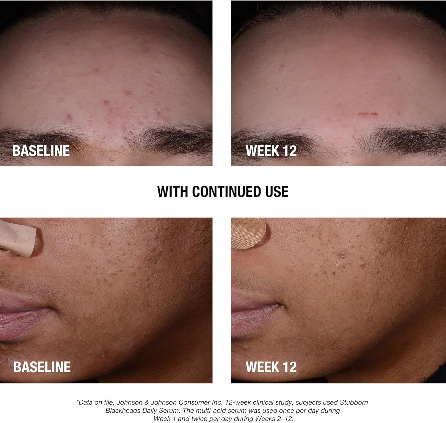 سرم صورت روزانه ضد جوش سرسیاه نوتروژینا حاوی اسید سالیسیلیک، گلیکولیک، پلی هیدروکسی و ماندلیک، سرم صورت فاقد چربی برای پوست مستعد آکنه برای کمک به پاکسازی منافذ مسدود شده، 30 میلی لیتر سرم صورت روزانه ضد جوش سرسیاه نوتروژینا حاوی اسید سالیسیلیک، گلیکولیک، پلی هیدروکسی و ماندلیک، سرم صورت فاقد چربی برای پوست مستعد آکنه برای کمک به پاکسازی منافذ مسدود شده، 30 میلی لیتر