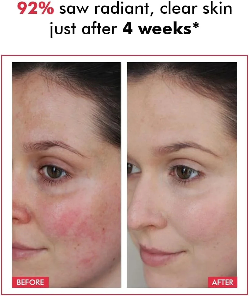 محلول لایه بردار %25 AHA، %2 BHA، %5 PHA کانشس کمست | 30 میلی لیتر | محلول پیشرفته لایه بردار AHA BHA، سرم ضد پیری، سرم لایه بردار برای رفع احتقان منافذ و خطوط ریز - Derm Date