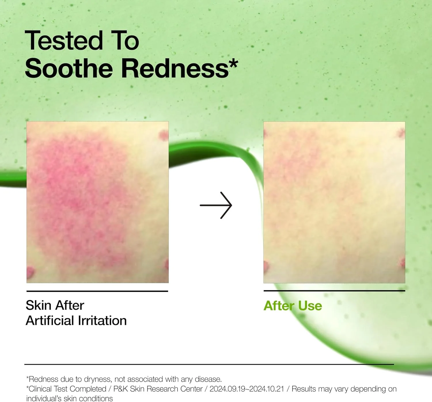 سرم تسکین دهنده قرمزی پوست آنوا حاوی آزالئیک اسید 10% و هیالورون، سرم صورت برای پوست حساس، حاوی هیالورونیک اسید و نیاسینامید، مراقبت از لک، رنگ طبیعی، وگان، مراقبت از پوست کره ای (30 میلی لیتر)