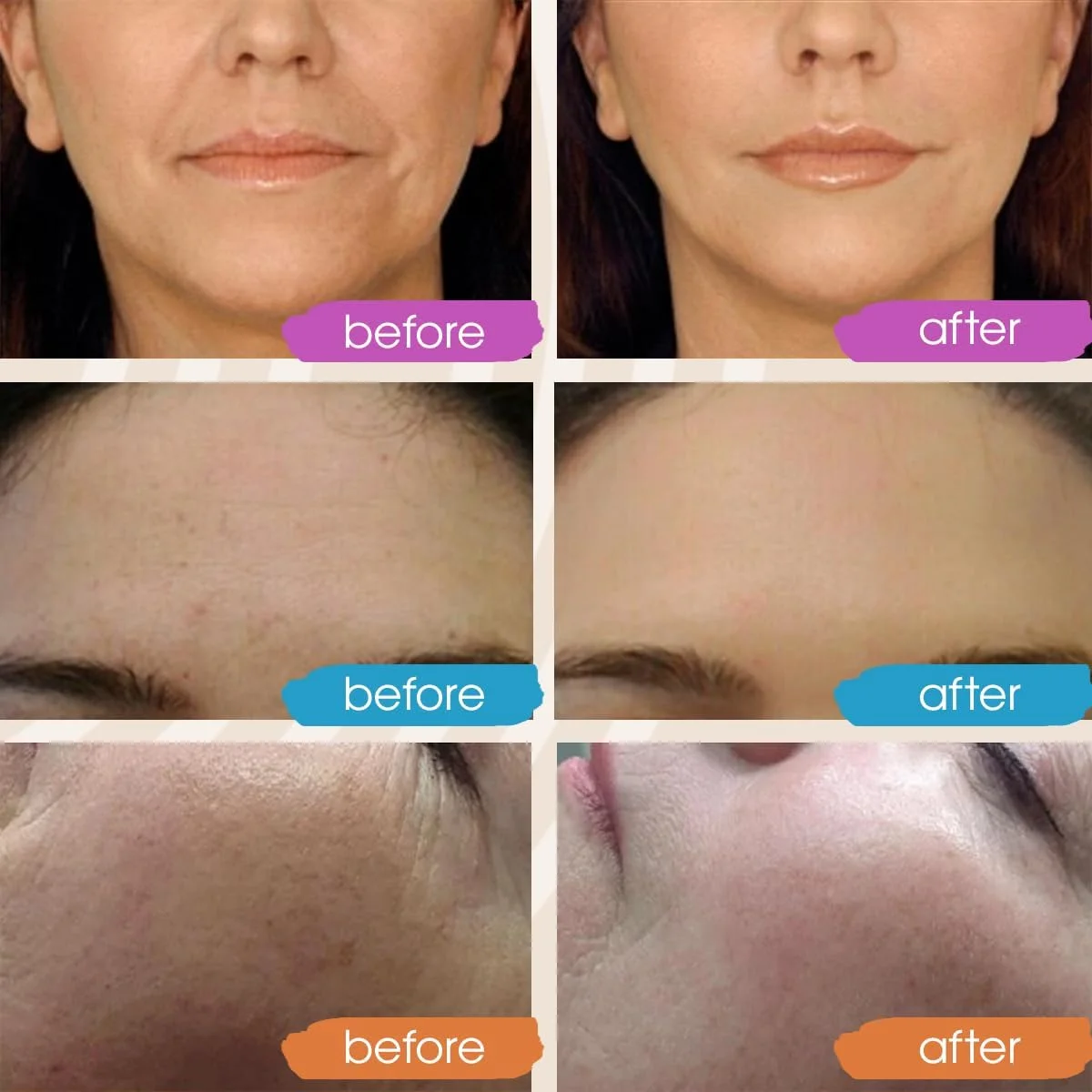 سرم صورت رتینول GLEOW با سرم صورت هیالورونیک اسید برای زنان، سرم شب آبرسان صورت، سرم صورت رتینول 2oz