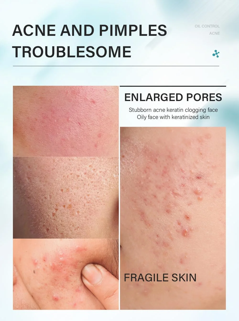 مجموعه ۴ تکه درمان پوست چرب و جوش دار حاوی درخت چای و سالیسیلیک اسید - کنترل چربی، کوچک کننده منافذ، پاک کننده آبرسان، تونر، سرم و کرم برای پوست مستعد لک - مواد طبیعی، روتین ملایم مراقبت روزانه از پوست