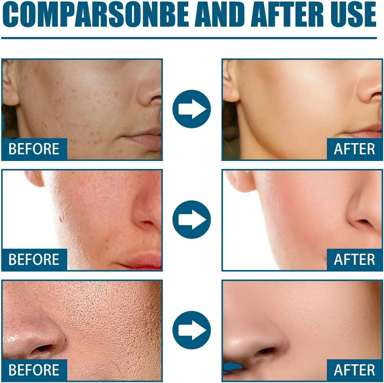 فوم شستشوی صورت آکنه، فوم پاک کننده ملایم روزانه صورت برای پاکسازی عمیق منافذ، شستشوی صورت بانوان، پاک کننده ملایم، فوم پاک کننده، شستشوی لایه بردار صورت، پاک کننده فوم، شستشوی صورت، فوم پاک کننده