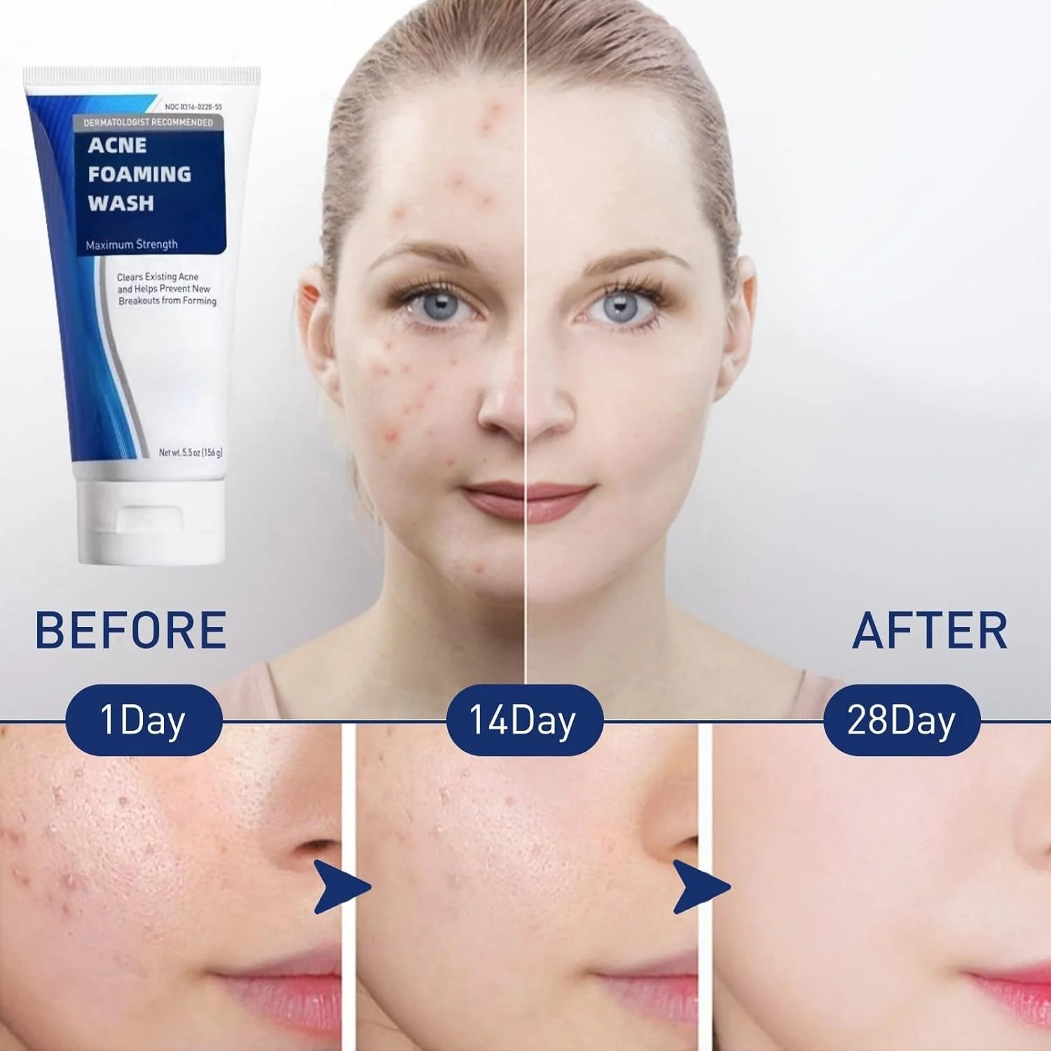 فوم شستشوی صورت آکنه، فوم پاک کننده ملایم روزانه صورت برای پاکسازی عمیق منافذ، شستشوی صورت بانوان، پاک کننده ملایم، فوم پاک کننده، شستشوی لایه بردار صورت، پاک کننده فوم، شستشوی صورت، فوم پاک کننده