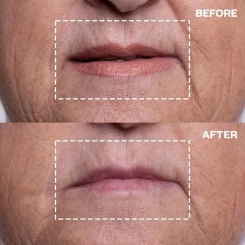 مجموعه لیفت چشم و دهان Wrinkles Schminkles | پچ رفع چروک دهان و لب 2 عددی و پچ رفع چروک چشم 3 جفتی | پچ های سیلیکونی قابل استفاده مجدد با گرید پزشکی
