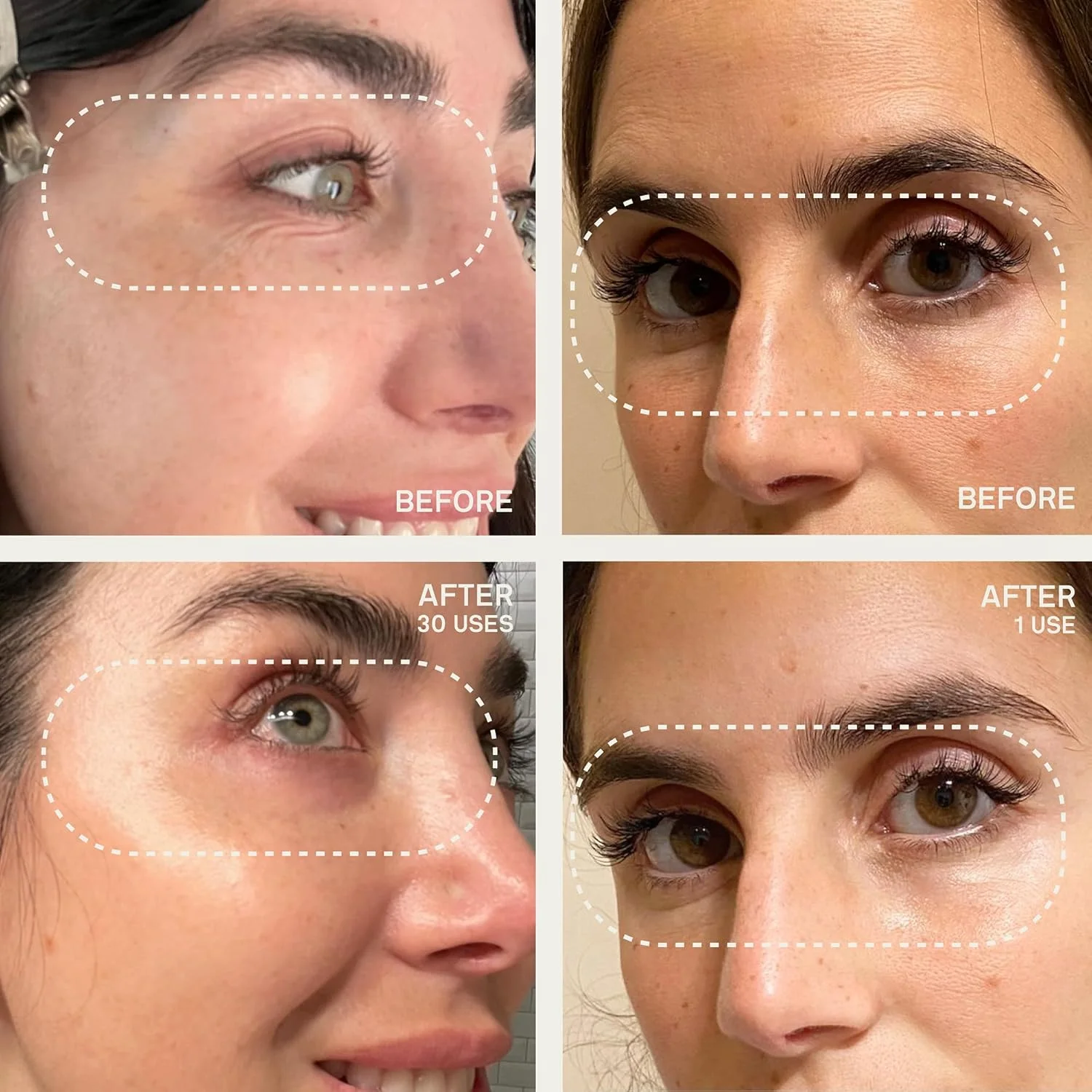 پدهای ضد چروک سیلیکونی Dermaclara - کیت درمان صورت قابل استفاده مجدد برای خطوط ریز، مراقبت از پوست ایمن در دوران بارداری - پدهای زیر چشم، پیشانی، گردن