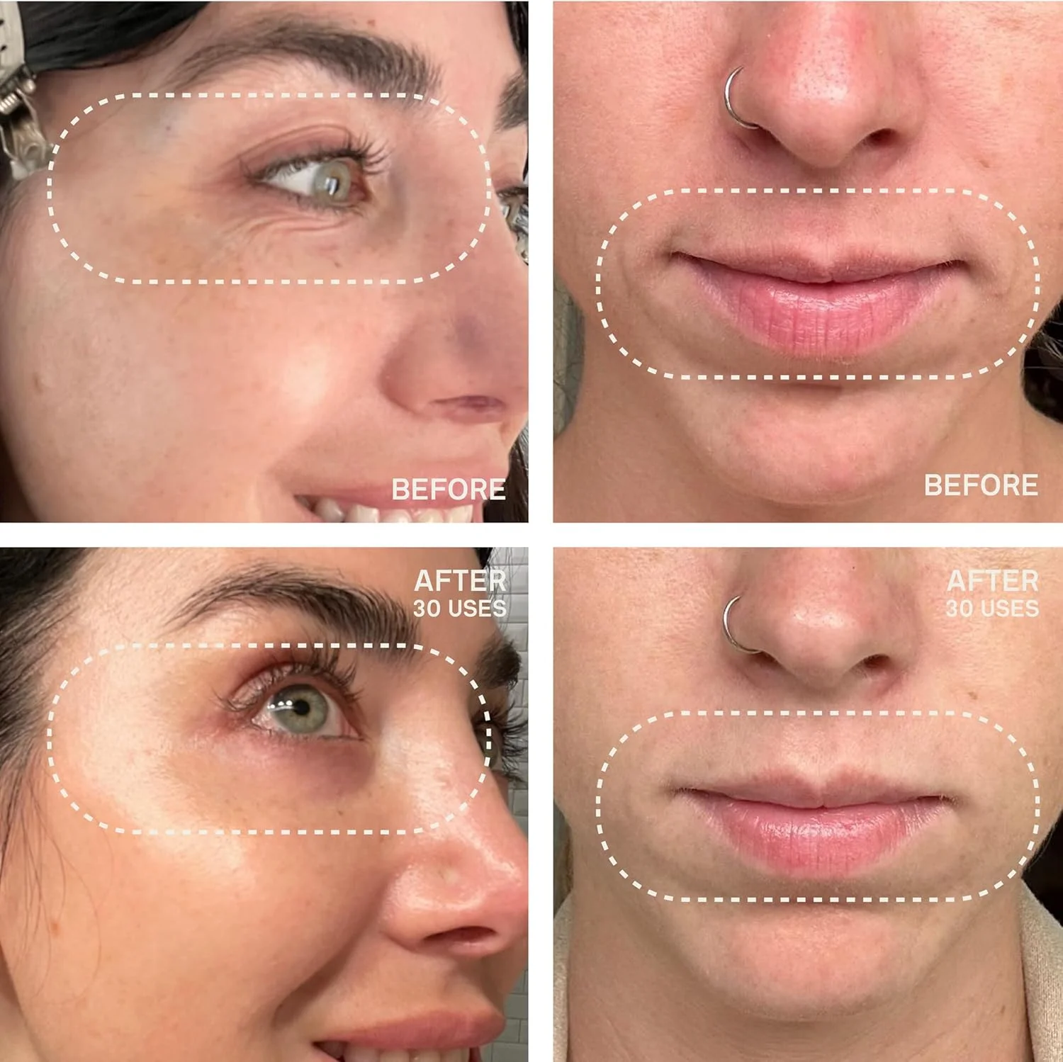 پدهای سیلیکونی بهبود یافته درماکلارا برای دور چشم و دهان