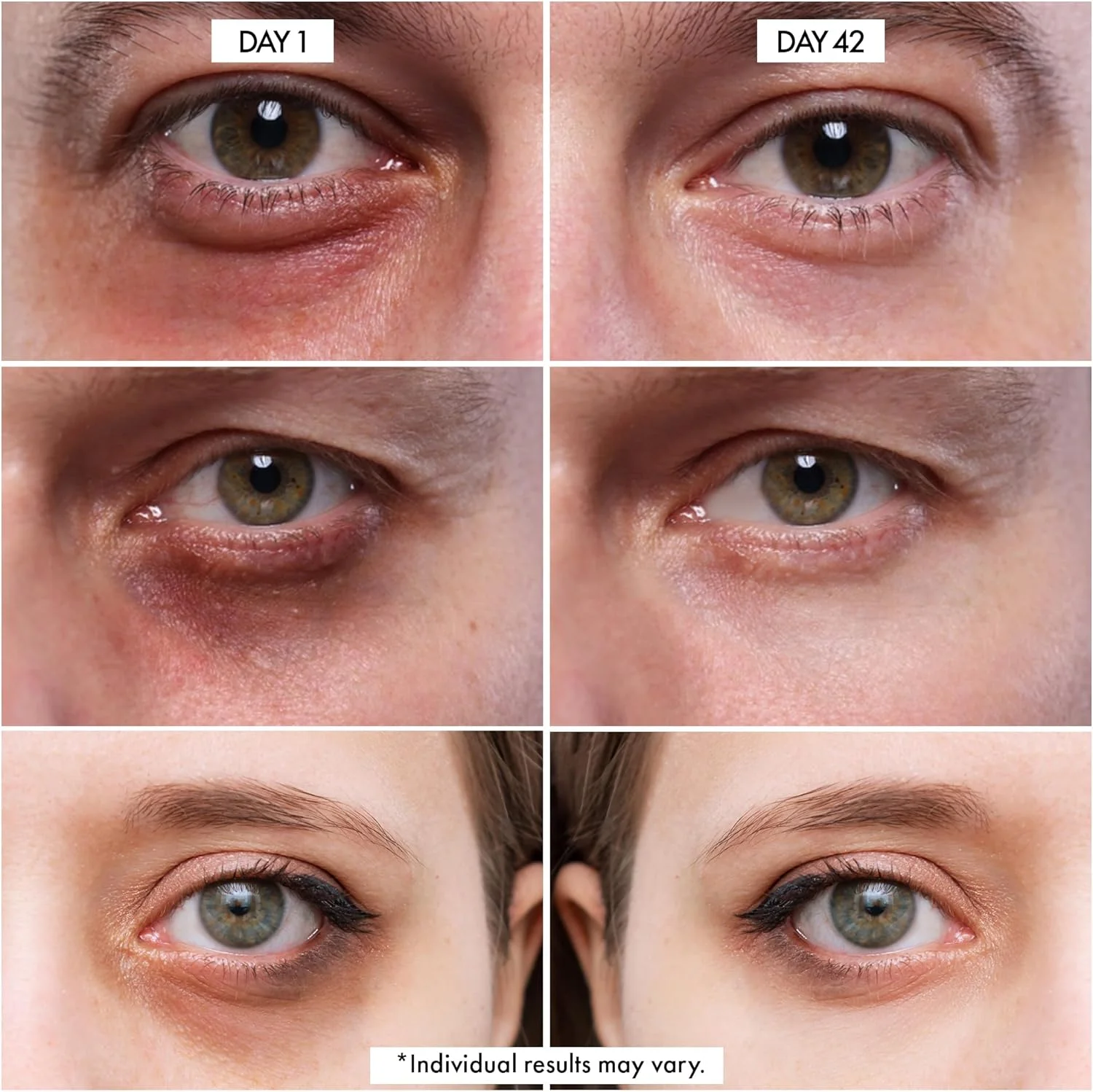 کرم دور چشم دکتر کریزی | کرم دور چشم برای سیاهی و پف زیر چشم | کرم ضد پیری حاوی پروبیوتیک، رتینول، کافئین و موارد دیگر | 30 میلی لیتر کرم دور چشم دکتر کریزی | کرم دور چشم برای سیاهی و پف زیر چشم | کرم ضد پیری حاوی پروبیوتیک، رتینول، کافئین و موارد دیگر | 30 میلی لیتر