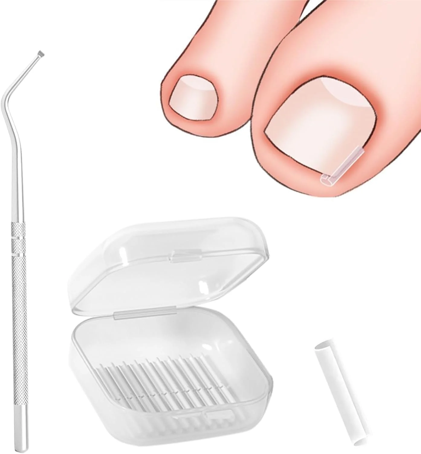 ست ناخن های فرورفته در گوشت، گیره اصلاح ناخن، کیت ناخن های فرورفته در گوشت، گیره اصلاح ناخن یکبار مصرف، برای اصلاح رشد ناخن های فرورفته در گوشت، مراقبت از پا، بسته 40 عددی