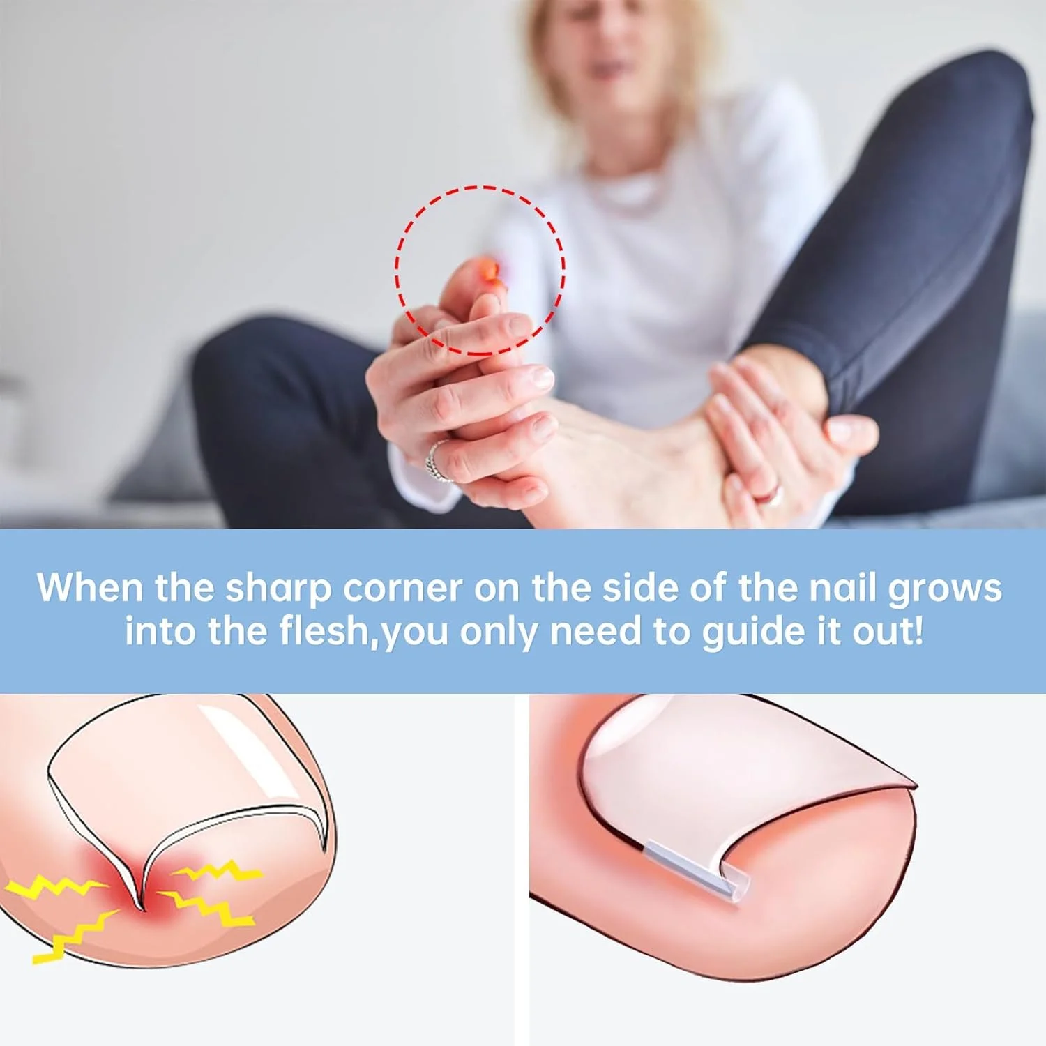 ست ناخن های فرورفته در گوشت، گیره اصلاح ناخن، کیت ناخن های فرورفته در گوشت، گیره اصلاح ناخن یکبار مصرف، برای اصلاح رشد ناخن های فرورفته در گوشت، مراقبت از پا، بسته 40 عددی