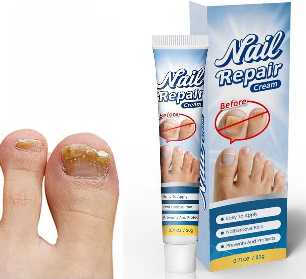 کرم ترمیم ناخن - درمان هدفمند 20 گرمی برای ناخن های آسیب دیده، موثر برای ناخن های ضخیم شده، ناخن های فرو رفته در گوشت و عفونت های قارچی، فرمول مغذی برای تقویت و ترمیم ناخن ها