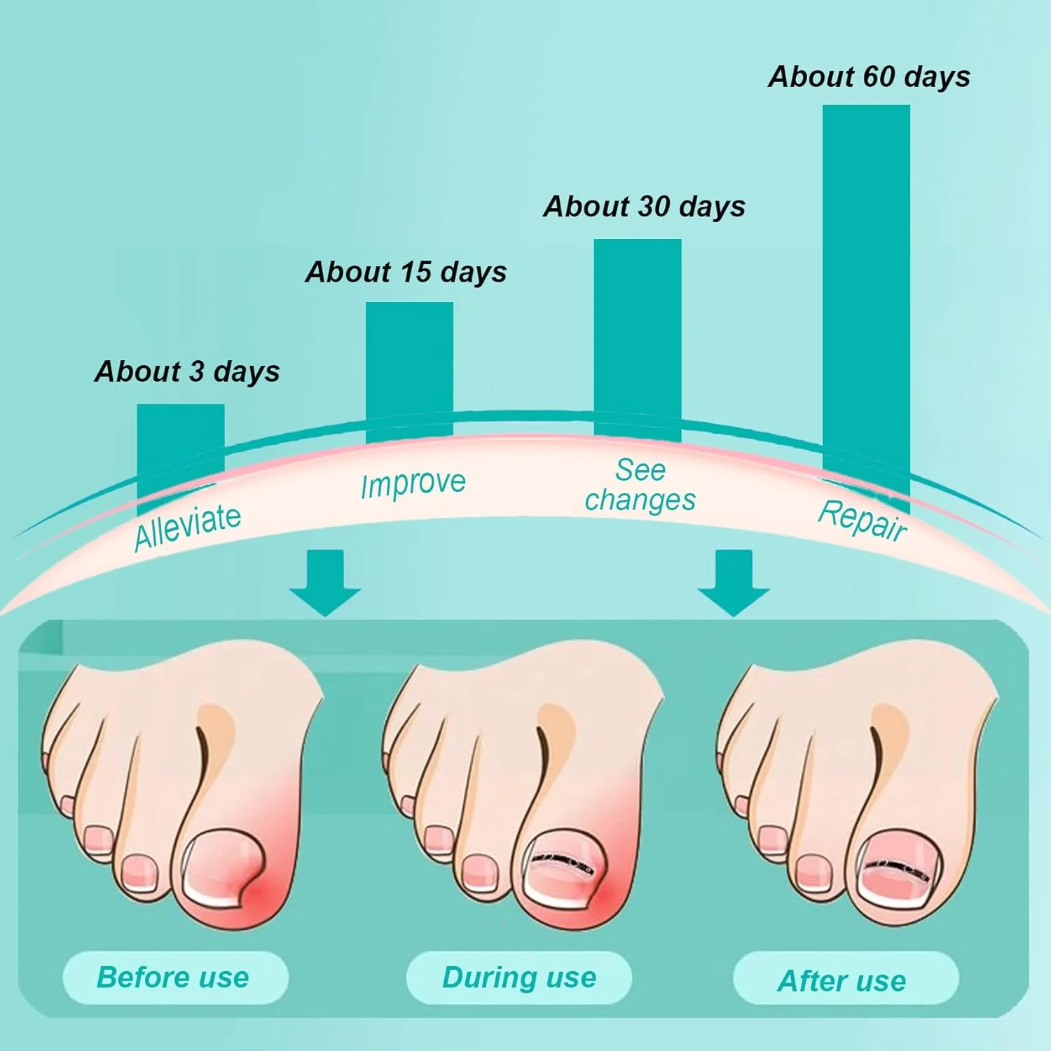 کیت درمان ناخن پا فرورفته نیتینول برای تسکین و اصلاح ناخن های پا فرورفته
