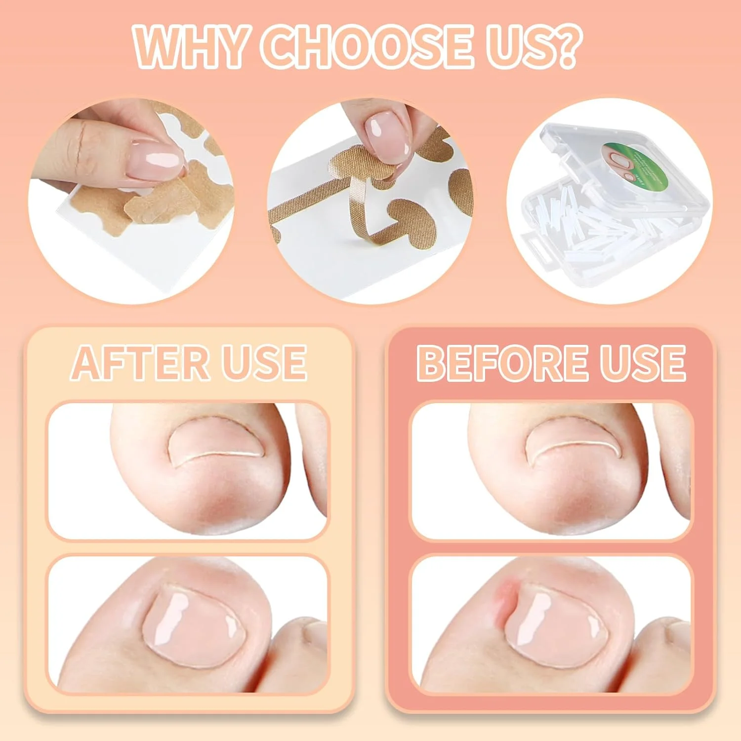 پد درمان ناخن فرورفته در گوشت، 2 نوع پد اصلاح ناخن، ابزار استیکر اصلاح ناخن فرورفته در گوشت، نوار الاستیک تنفسی ناخن پا، پد چسبی برای مراقبت از ناخن فرورفته در گوشت