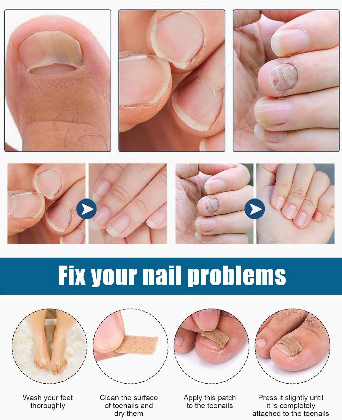 ۹۶ عدد پد اصلاح کننده تنفسی + ۸۰ عدد استیکر ناخن فرورفته - کیت درمان حرفه ای تسکین درد و پیشگیری