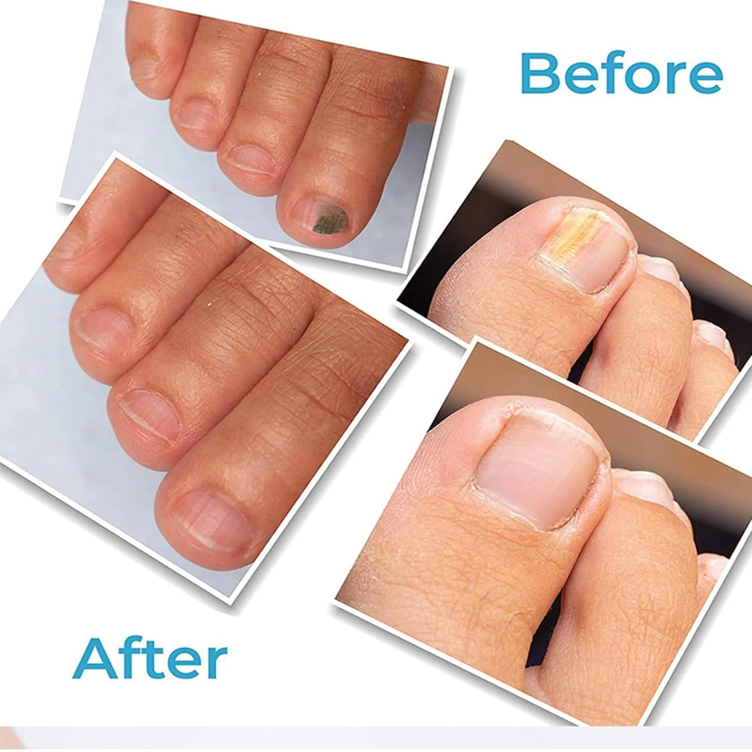 قلم ترمیم ناخن، ست 4 عددی ترمیم ناخن، درمان ناخن ترک خورده، تقویت کننده ناخن های آسیب دیده، آبرسانی لایه های بیرونی، کاربرد چند منظوره برای ناخن های دست و پا، نفوذ عمیق