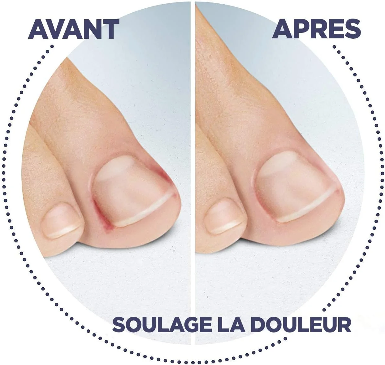 کیت درمان ناخن فرورفته در پا شول (گیره و اسپری) - درمان ناخن فرورفته