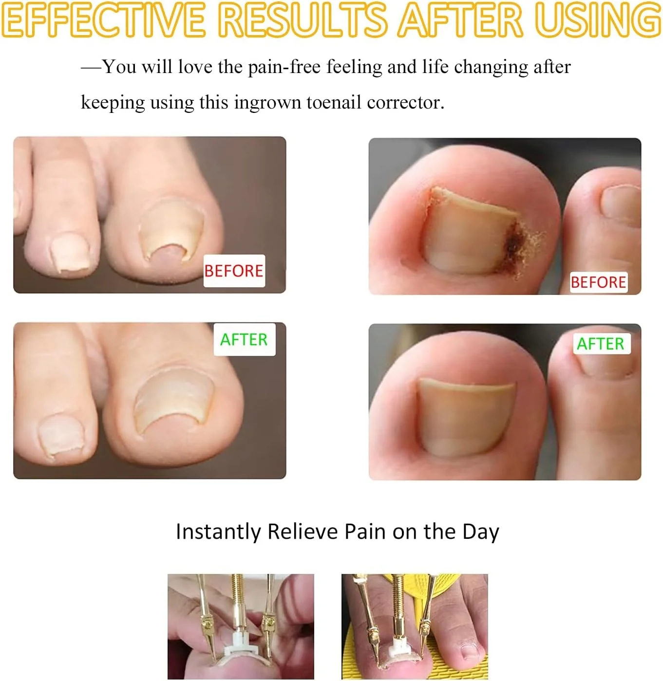 کیت درمان ناخن فرورفته MAKINGTEC با 12 بریس ناخن، لیفتر ناخن فرورفته مسی خالص، ابزار مراقبت از پا فولادی برای پارونیشیا کیت درمان ناخن فرورفته MAKINGTEC با 12 بریس ناخن، لیفتر ناخن فرورفته مسی خالص، ابزار مراقبت از پا فولادی برای پارونیشیا