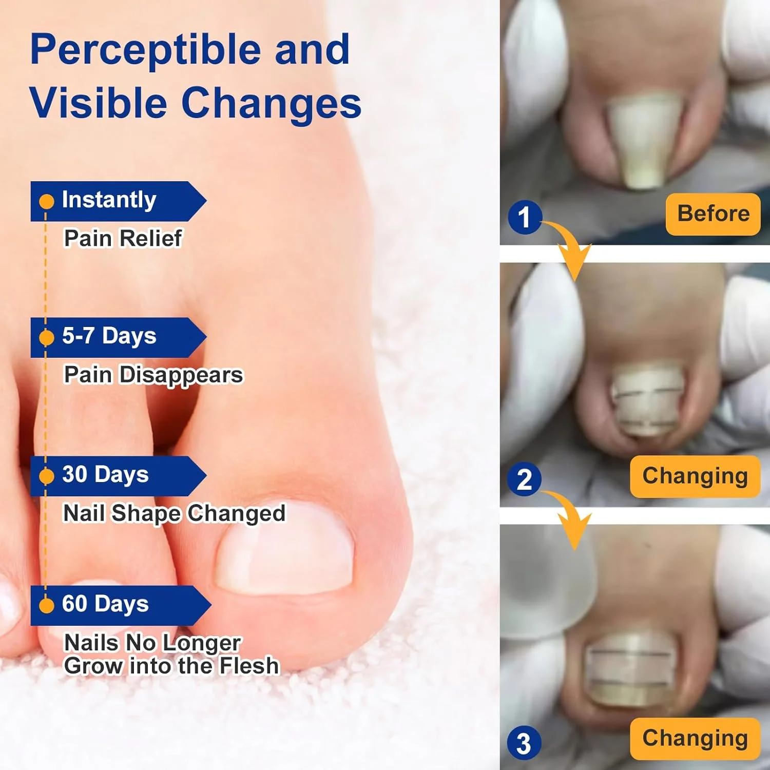 صاف کننده ناخن پا از جنس نیتینول، درمان خانگی ناخن فرو رفته، صاف کننده ناخن خمیده، تسکین دهنده درد ناخن فرو رفته، کیت برداشتن ناخن فرو رفته (11/16 اینچ، 13/16 اینچ)