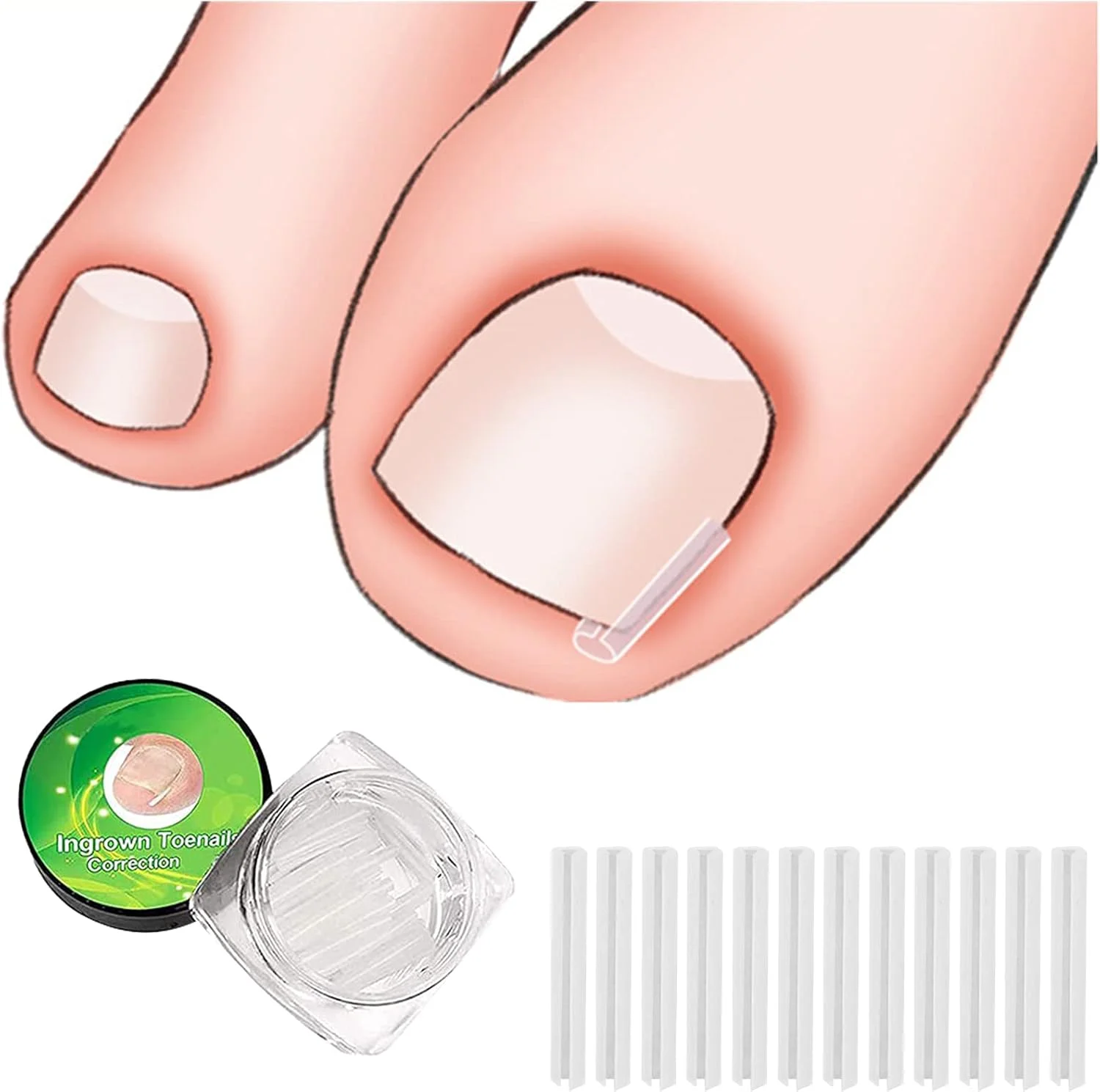 مجموعه (32 عددی) ابزار درمان ناخن فرورفته در گوشت، شامل 30 عدد نوار اصلاح ناخن فرورفته، ابزار پدیکور ناخن فرورفته و 2 عدد ابزار لیفتر و سوهان ناخن فرورفته