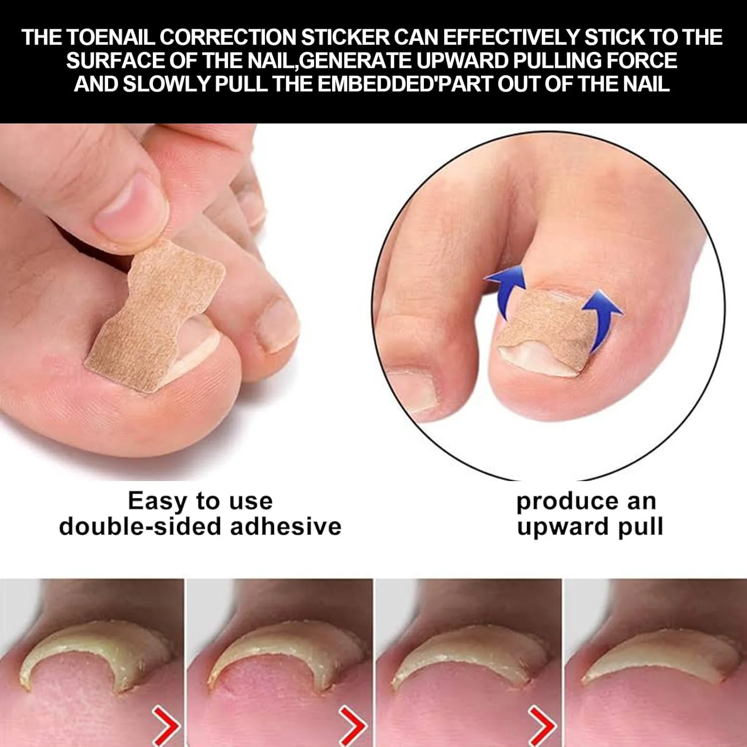 کیت درمان ناخن فرورفته Wisfunlly، نوارهای اصلاح کننده ناخن فرورفته به همراه سوهان و لیفتر، ابزار بدون درد شامل بریس ناخن خمیده و استیکر اصلاح کننده ناخن